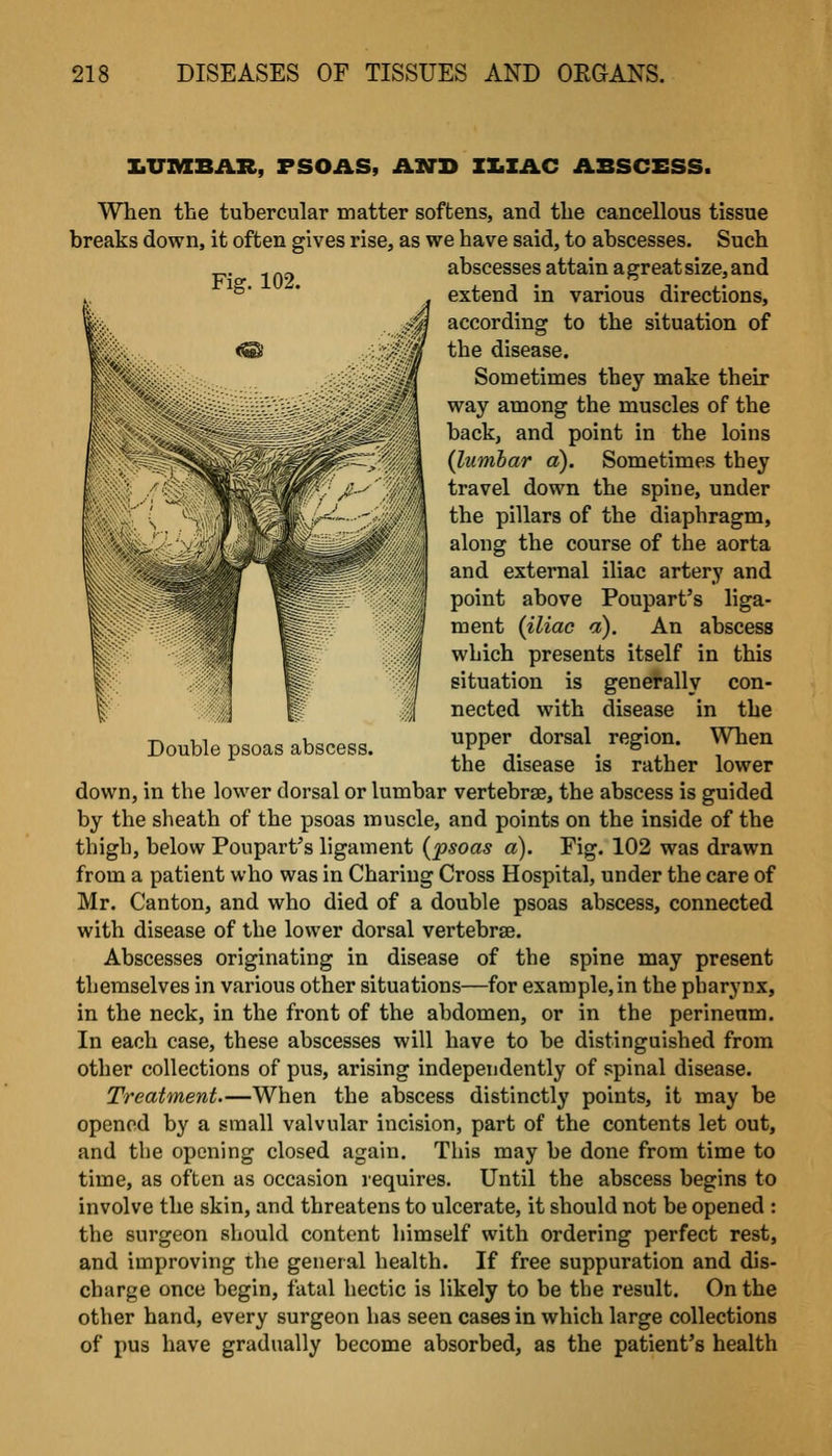 I.UMBAR, FSOAS, ANH ZX.ZAC ABSCESS. When the tubercular matter softens, and the cancellous tissue breaks down, it often gives rise, as we have said, to abscesses. Such ^ -- abscesses attain agreatsize,and °' * extend in various directions, according to the situation of the disease. Sometimes they make their way among the muscles of the back, and point in the loins (luTnbar a). Sometimes they travel down the spine, under the pillars of the diaphragm, along the course of the aorta and external iliac artery and point above Poupart's liga- ment {iliac a). An abscess which presents itself in this situation is generally con- nected with disease in the upper dorsal region. When the disease is rather lower down, in the lower dorsal or lumbar vertebrae, the abscess is guided by the sheath of the psoas muscle, and points on the inside of the thigh, below Poupart's ligament (psoas a). Fig. 102 was drawn from a patient who was in Charing Cross Hospital, under the care of Mr. Canton, and who died of a double psoas abscess, connected with disease of the lower dorsal vertebrae. Abscesses originating in disease of the spine may present themselves in various other situations—for example, in the pharynx, in the neck, in the front of the abdomen, or in the perineum. In each case, these abscesses will have to be distinguished from other collections of pus, arising independently of spinal disease. Treatment.—When the abscess distinctly points, it may be opened by a small valvular incision, part of the contents let out, and the opening closed again. This may be done from time to time, as often as occasion requires. Until the abscess begins to involve the skin, and threatens to ulcerate, it should not be opened: the surgeon should content himself with ordering perfect rest, and improving the general health. If free suppuration and dis- charge once begin, fatal hectic is likely to be the result. On the other hand, every surgeon has seen cases in which large collections of pus have gradually become absorbed, as the patient's health Double psoas abscess.