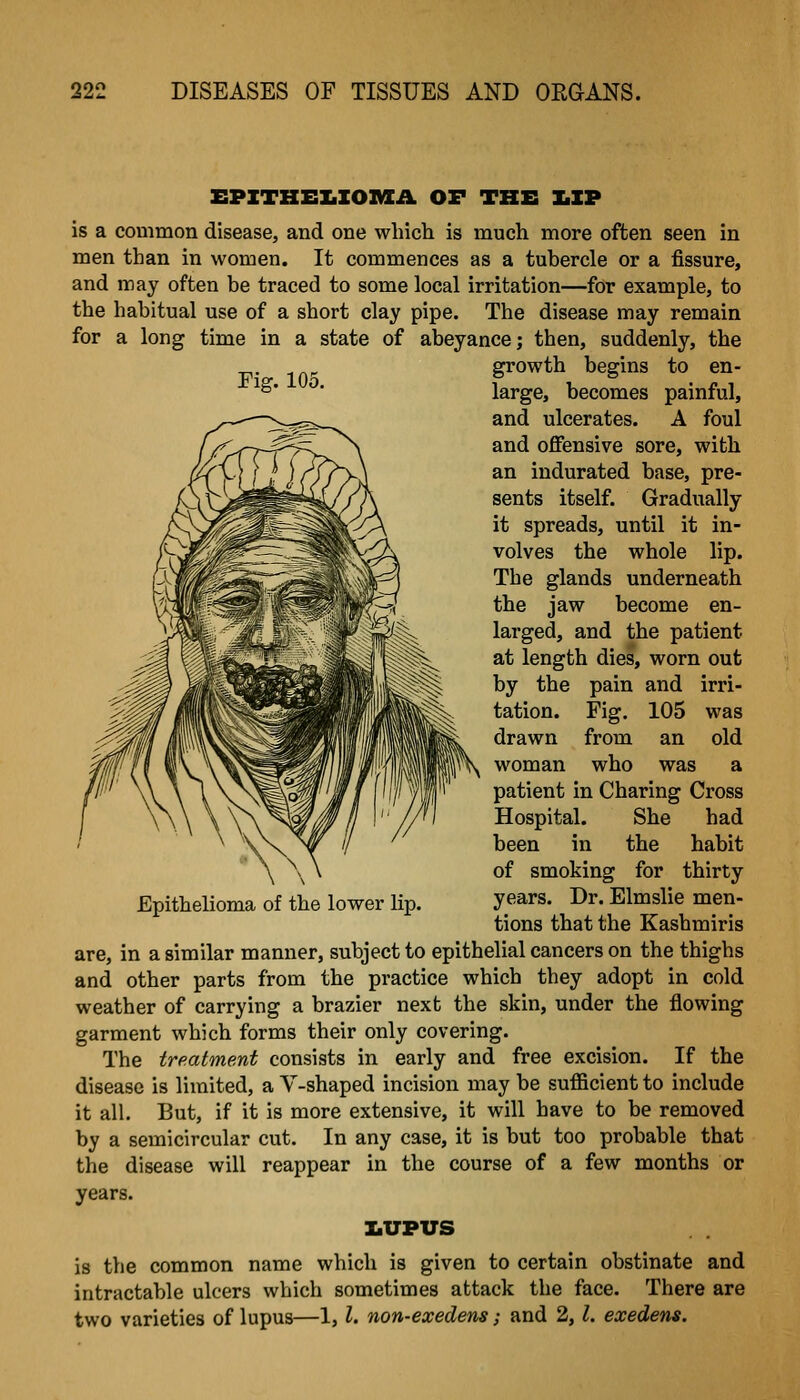 EPZTHEILIOMA OF THE I.IP is a common disease, and one which is much more often seen in men than in women. It commences as a tubercle or a fissure, and may often be traced to some local irritation—for example, to the habitual use of a short clay pipe. The disease may remain for a long time in a state of abeyance; then, suddenly, the growth begins to en- ^^' ^' large, becomes painful, and ulcerates. A foul and offensive sore, with an indurated base, pre- sents itself. Gradually it spreads, until it in- volves the whole lip. The glands underneath the jaw become en- larged, and the patient at length dies, worn out by the pain and irri- tation. Fig. 105 was drawn from an old woman who was a patient in Charing Cross Hospital. She had been in the habit of smoking for thirty Epithelioma of the lower lip. years. Dr. Elmslie men- tions that the Kashmiris are, in a similar manner, subject to epithelial cancers on the thighs and other parts from the practice which they adopt in cold weather of carrying a brazier next the skin, under the flowing garment which forms their only covering. The treatment consists in early and free excision. If the disease is limited, a V-shaped incision may be sufficient to include it all. But, if it is more extensive, it will have to be removed by a semicircular cut. In any case, it is but too probable that the disease will reappear in the course of a few months or years. X.UPUS is the common name which is given to certain obstinate and intractable ulcers which sometimes attack the face. There are two varieties of lupus—1,1, non-exedens; and 2,1, exedens.