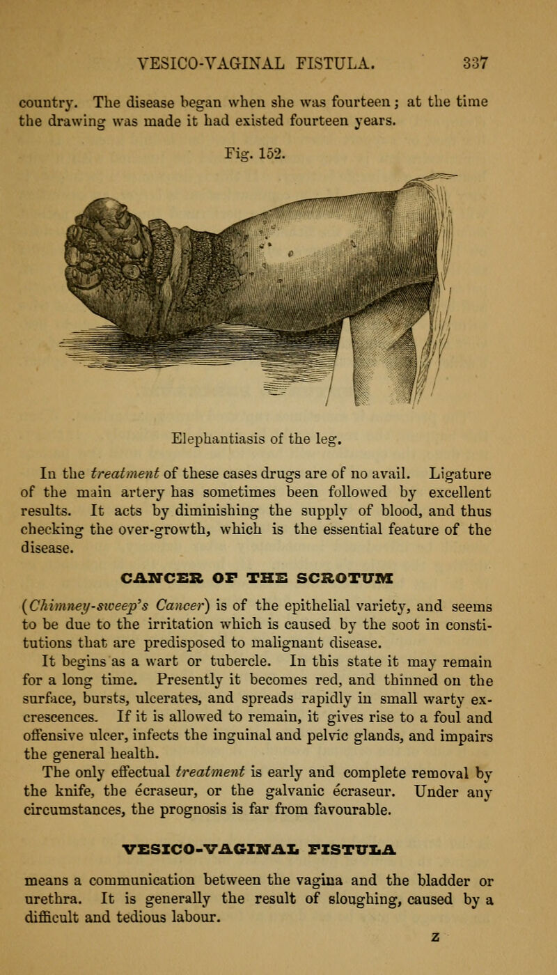 country. The disease began when she was fourteen; at the time the drawing was made it had existed fourteen years. Fii?. 152. Elephantiasis of the leg. In the treatment of these cases drugs are of no avail. Ligature of the main artery has sometimes been followed by excellent results. It acts by diminishing the supply of blood, and thus checking the over-growth, which is the essential feature of the disease. CAXrCER OF TH& SCROTUAX (^Chimney-sweep's Cancer) is of the epithelial variety, and seems to be due to the irritation which is caused by the soot in consti- tutions that are predisposed to malignant disease. It begins as a wart or tubercle. In this state it may remain for a long time. Presently it becomes red, and thinned on the surf>ice, bursts, ulcerates, and spreads rapidly in small warty ex- crescences. If it is allowed to remain, it gives rise to a foul and offensive ulcer, infects the inguinal and pelvic glands, and impairs the general health. The only effectual treatment is early and complete removal by the knife, the ecraseur, or the galvanic ecraseur. Under any circumstances, the prognosis is far from favourable. VESZCO-VAGIZTAXi FISTTTIiA means a communication between the vagina and the bladder or urethra. It is generally the result of sloughing, caused by a difficult and tedious labour. z