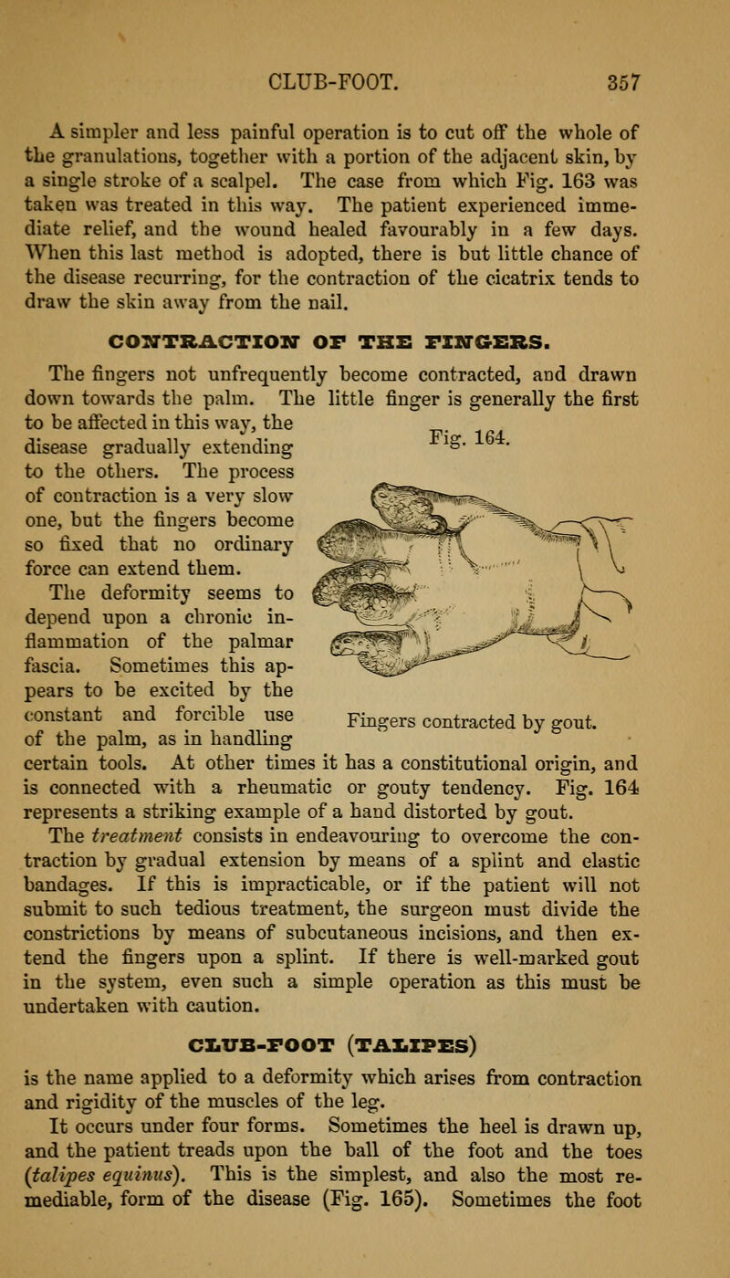 A simpler and less painful operation is to cut off the whole of the granulations, togetlier with a portion of the adjacent skin, by a single stroke of a scalpel. The case from which Fig. 163 was taken was treated in this way. The patient experienced imme- diate relief, and the wound healed favourably in a few days. When this last method is adopted, there is but little chance of the disease recurring, for the contraction of the cicatrix tends to draw the skin away from the nail. COXTRACTIOX OF THE FZUG-ERS. The fingers not unfrequently become contracted, and drawn down towards the palm. The little finger is generally the first to be affected in this way, the disease gradually extending to the others. The process of contraction is a very slow one, but the fingers become so fixed that no ordinary force can extend them. The deformity seems to depend upon a chronic in- flammation of the palmar fascia. Sometimes this ap- pears to be excited by the constant and forcible use of the palm, as in handlhig Fiff. 164. Fingers contracted by gout. certain tools. At other times it has a constitutional origin, and is connected with a rheumatic or gouty tendency. Fig. 164 represents a striking example of a hand distorted by gout. The treatment consists in endeavouring to overcome the con- traction by gradual extension by means of a splint and elastic bandages. If this is impracticable, or if the patient will not submit to such tedious treatment, the surgeon must divide the constrictions by means of subcutaneous incisions, and then ex- tend the fingers upon a splint. If there is well-marked gout in the system, even such a simple operation as this must be undertaken with caution. CZilTB-FOOT (TAIiIPES) is the name applied to a deformity which arises from contraction and rigidity of the muscles of the leg. It occurs under four forms. Sometimes the heel is drawn up, and the patient treads upon the ball of the foot and the toes (talipes eqiiinus). This is the simplest, and also the most re- mediable, form of the disease (Fig. 165). Sometimes the foot