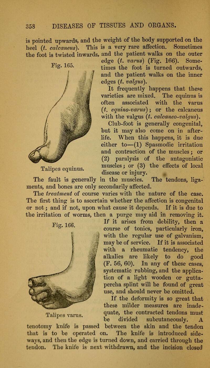 Talipes equinus. is pointed upwards, and the weight of the hody supported on the heel {t. calcaneus). This is a very rare affection. Sometimes the foot is twisted inwards, and the patient walks on the outer edge {t. varus) (Fig. 166). Some- times the foot is turned outwards, and the patient walks on the inner edges {t. valgus). It frequently happens that these varieties are mixed. The equinus is often associated with the varus {t. equino-varus); or the calcaneus with the valgus (t. calcaneo-valgus). Club-foot is generally congenital, but it may also come on in after- life. When this happens, it is due either to—(1) Spasmodic irritation and contraction of the muscles; or (2) paralysis of the antagonistic muscles; or (3) the effects of local disease or injury. The fault is generally in the muscles. The tendons, liga- ments, and bones are only secondarily affected. The treatment of course varies with the nature of the case. The first thing is to ascertain whether the affection is congenital or not; and if not, upon what cause it depends. If it is due to the irritation of worms, then a purge may aid in removing it. If it arises from debility, then a course of tonics, particularly iron, with the regular use of galvanism, may be of service. If it is associated with a rheumatic tendency, the alkalies are likely to do good (F. 56, 60). In any of these cases, systematic rubbing, and the applica- tion of a light wooden or gutta- percha splint will be found of great use, and should never be omitted. If the deformity is so great that these milder measures are inade- quate, the contracted tendons must be divided subcutaneously. A between the skin and the tendon that is to be operated on. The knife is introduced side- ways, and then the edge is turned down, and carried through the tendon. The knife is next withdrawn, and the incision closed Fig. 166. Talipes varus, tenotomy knife is passed