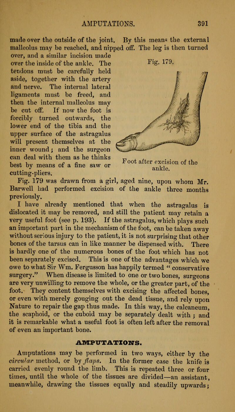 Fig. 179. Foot after excision of the ankle. made over the outside of the joint. By this means the external malleolus may he reached, and nipped off. The leg is then turned over, and a similar incision made over the inside of the ankle. The tendons must be carefully held aside, together with the artery and nerve. The internal lateral ligaments must be freed, and then the internal malleolus may be cut off. If now the foot is forcibly turned outwards, the lower end of the tibia and the upper surface of the astragalus will present themselves at the inner wound; and the surgeon can deal with them as he thinks best by means of a fine saw or cutting-pliers. Fig. 179 was drawn from a girl, aged nine, upon whom Mr. Barwell had performed excision of the ankle three months previously. I have already mentioned that when the astragalus is dislocated it may be removed, and still the patient may retain a very useful foot (see p. 193). If the astragalus, which plays such an important part in the mechanism of the foot, can be taken away without serious injury to the patient, it is not surprising that other bones of the tarsus can in like manner be dispensed with. There is hardly one of the numerous bones of the foot Avhich has not been separately excised. This is one of the advantages which we owe to what Sir Wm. Fergusson has happily termed  conservative surgery. When disease is limited to one or two bones, surgeons are very unwilling to remove the whole, or the greater part, of the foot. They content themselves with excising the affected bones, or even with merely gouging out the dead tissue, and rely upon Nature to repair the gap thus made. In this way, the calcaneum, the scaphoid, or the cuboid may be separately dealt with ; and it is remarkable what a useful foot is often left after the removal of even an important bone. AXVIPUTiLTIOIirS. Amputations may be performed in two ways, either by the circular method, or by flaps. In the former case the knife is carried evenly round the limb. This is repeated three or four times, until the whole of the tissues are divided—an assistant, meanwhile, drawing the tissues equally and steadily upwards;