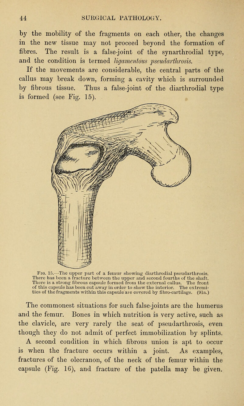 by the mobility of the fragments on each other, the changes in the new tissue may not proceed beyond the formation of fibres. The result is a false-joint of the synarthrodia! type, and the condition is termed ligamentous pseudarthrosis. If the movements are considerable, the central parts of the callus may break down, forming a cavity which is surrounded by fibrous tissue. Thus a false-joint of the diarthrodial type is formed (see Fig. 15). Fig. 15.—The upper part of a femur showing diarthrodial pseudarthrosis. There has been a fracture between the upper and second fourths of the shaft. There is a strong fibrous capsule formed from the external callus. The front of this capsule has been cut away in order to show the interior. The extremi- ties of the fragments within this capsule are covered by fibro-cartilage. (91a.) The commonest situations for such false-joints are the humerus and the femur. Bones in which nutrition is very active, such as the clavicle, are very rarely the seat of pseudarthrosis, even though they do not admit of perfect immobilization by splints. A second condition in which fibrous union is apt to occur is when the fracture occurs within a joint. As examples, fractures of the olecranon, of the neck of the femur within the capsule (Fig. 16), and fracture of the patella may be given.