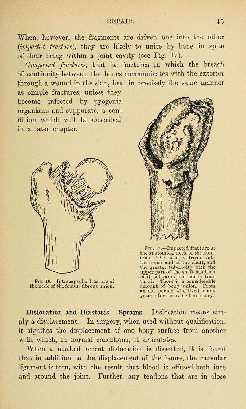 When, however, the fragments are driven one into the other (impacted fracture), they are likely to unite by bone in spite of their being within a joint cavity (see Fig. 17). Compound fractures, that is, fractures in which the breach of continuity between the bones communicates with the exterior through a wound in the skin, heal in precisely the same manner as simple fractures, unless they become infected by pyogenic organisms and suppurate, a con- dition which will be described in a later chapter. Fio. 16.—Intracapsular fracture of the neck of the femur, fibrous union. Fig. 17.—Impacted fracture at the anatomical neck of the hum- erus. The liead is driven into the upper end of the shaft, and the greater tuberosity with the upper part of the shaft has been bent outwards and partly frac- tured. There is a considerable amount of bony union. From an old person who lived many years after receiving the injury. Dislocation and Diastasis. Sprains. Dislocation means sim- ply a displacement. In surgery, when used without qualification, it signifies the displacement of one bony surface from another with which, in normal conditions, it articulates. When a marked recent dislocation is dissected, it is found that in addition to the displacement of the bones, the capsular ligament is torn, with the result that blood is efiused both into and around the joint. Further, any tendons that are in close