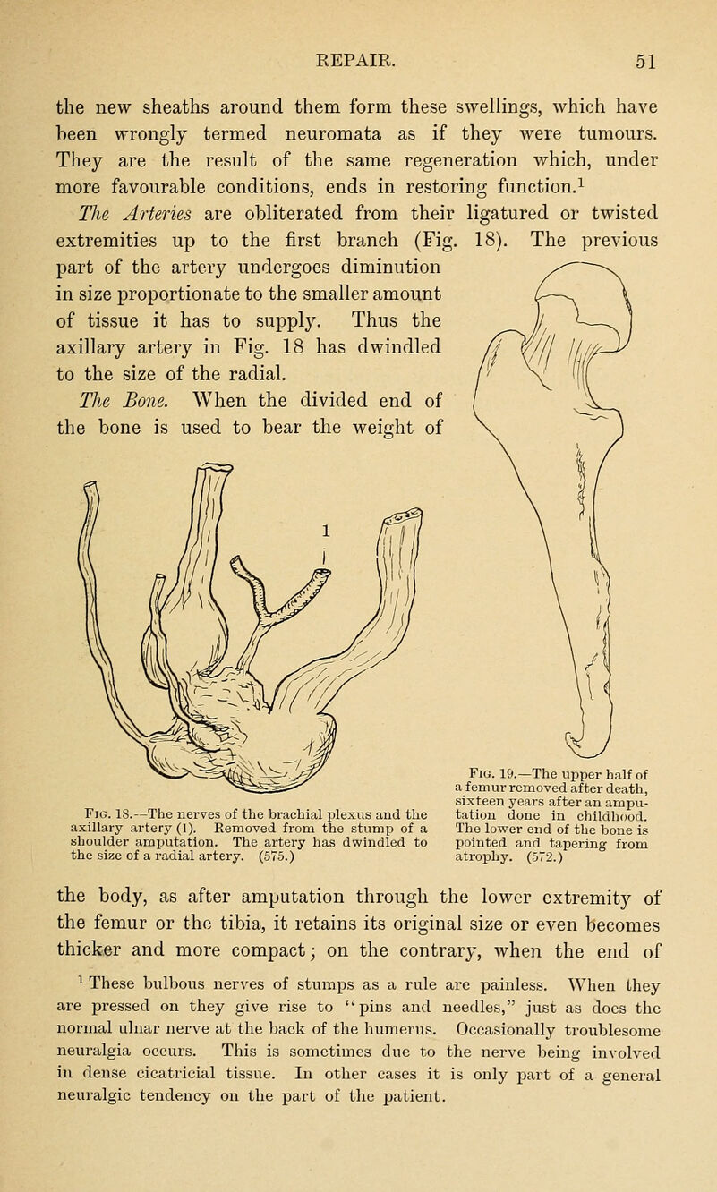 the new sheaths around them form these swellings, which have been wrongly termed neuromata as if they were tumours. They are the result of the same regeneration which, under more favourable conditions, ends in restoring function.^ The Arteries are obliterated from their ligatured or twisted extremities up to the first branch (Fig. 18). The previous part of the artery undergoes diminution in size proportionate to the smaller amount of tissue it has to supply. Thus the axillary artery in Fig. 18 has dwindled to the size of the radial. The Bone. When the divided end of the bone is used to bear the weight of Fig. is.—The nerves of the brachial plexus and the axillary artery (1). Removed from the stump of a shoulder amputation. The artery has dwindled to the size of a radial artery. (575.) Fig. 19.—The upper half of a femur removed after death, sixteen years after an ampu- tation done in childhood. The lower end of the bone is jjointed and tapering from atrophy. (572.) the body, as after amputation through the lower extremity of the femur or the tibia, it retains its original size or even becomes thicker and more compact; on the contrary, when the end of ^ These bulbous nerves of stumps as a rule are painless. When they are pressed on they give rise to pins and needles, just as does the normal ulnar nerve at the back of the humerus. Occasionally troublesome neuralgia occurs. This is sometimes due to the nerve being involved in dense cicatricial tissue. In other cases it is only part of a general neuralgic tendency on the part of the patient.