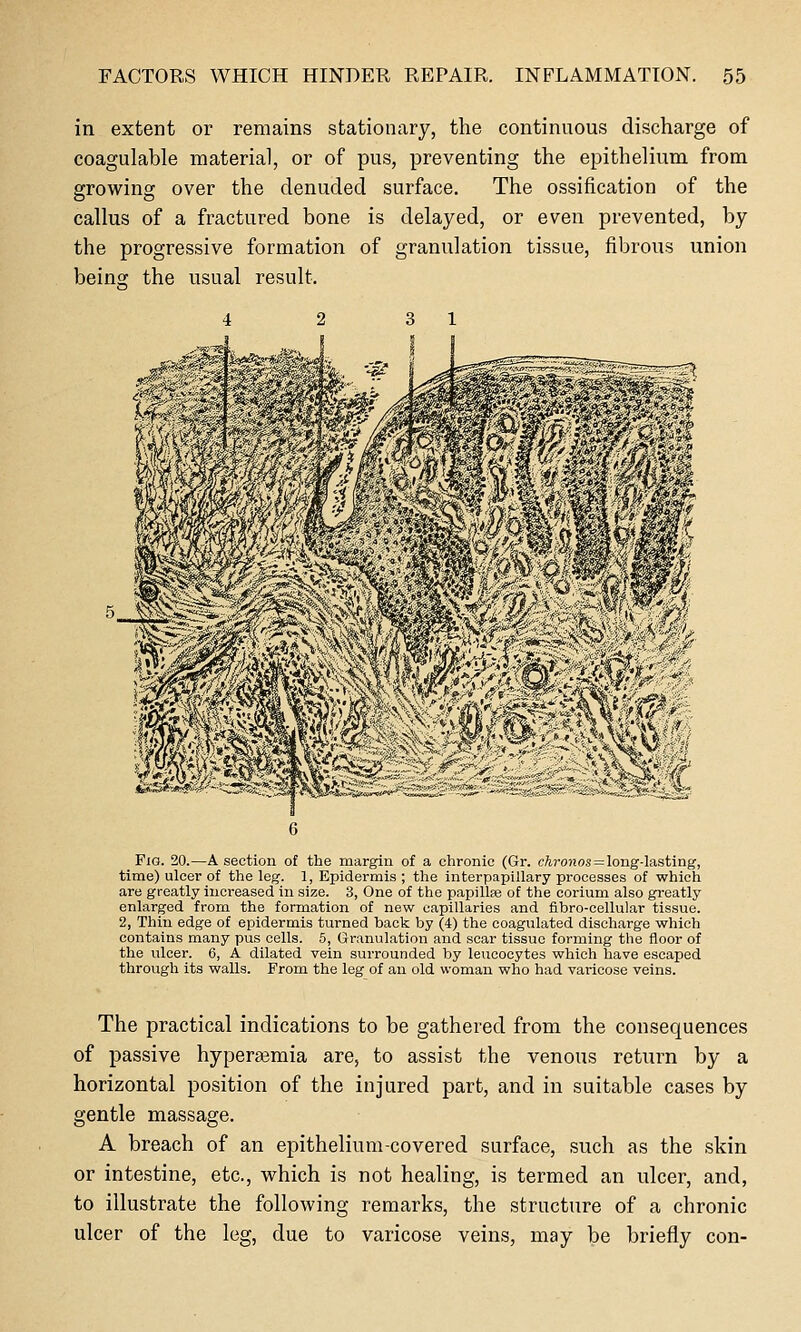 in extent or remains stationary, the continuous discharge of coagulable material, or of pus, preventing the epithelium from growing over the denuded surface. The ossification of the callus of a fractured bone is delayed, or even prevented, by the progressive formation of granulation tissue, fibrous union beinw the usual result. Fig. 20.—A section of the margin of a chronic (Gr. chronns = \ong-\a,st\ng, time) ulcer of the leg. 1, Epidermis ; the interpapillary processes of which are greatly increased in size. 3, One of the papillte of the corium also greatly enlarged from the formation of new capillaries and fibro-cellular tissue. 2, Thin edge of epidermis turned back by (4) the coagulated discharge which contains many pus cells. 5, Granulation and scar tissue forming the floor of the ulcer. 6, A dilated vein surrounded by leucocytes which have escaped through its walls. From the leg of an old woman who had varicose veins. The practical indications to be gathered from the consequences of passive hyperajmia are, to assist the venous return by a horizontal position of the injured part, and in suitable cases by gentle massage. A breach of an epithelium-covered surface, such as the skin or intestine, etc., which is not healing, is termed an ulcer, and, to illustrate the following remarks, the structure of a chronic ulcer of the leg, due to varicose veins, may be briefly con-