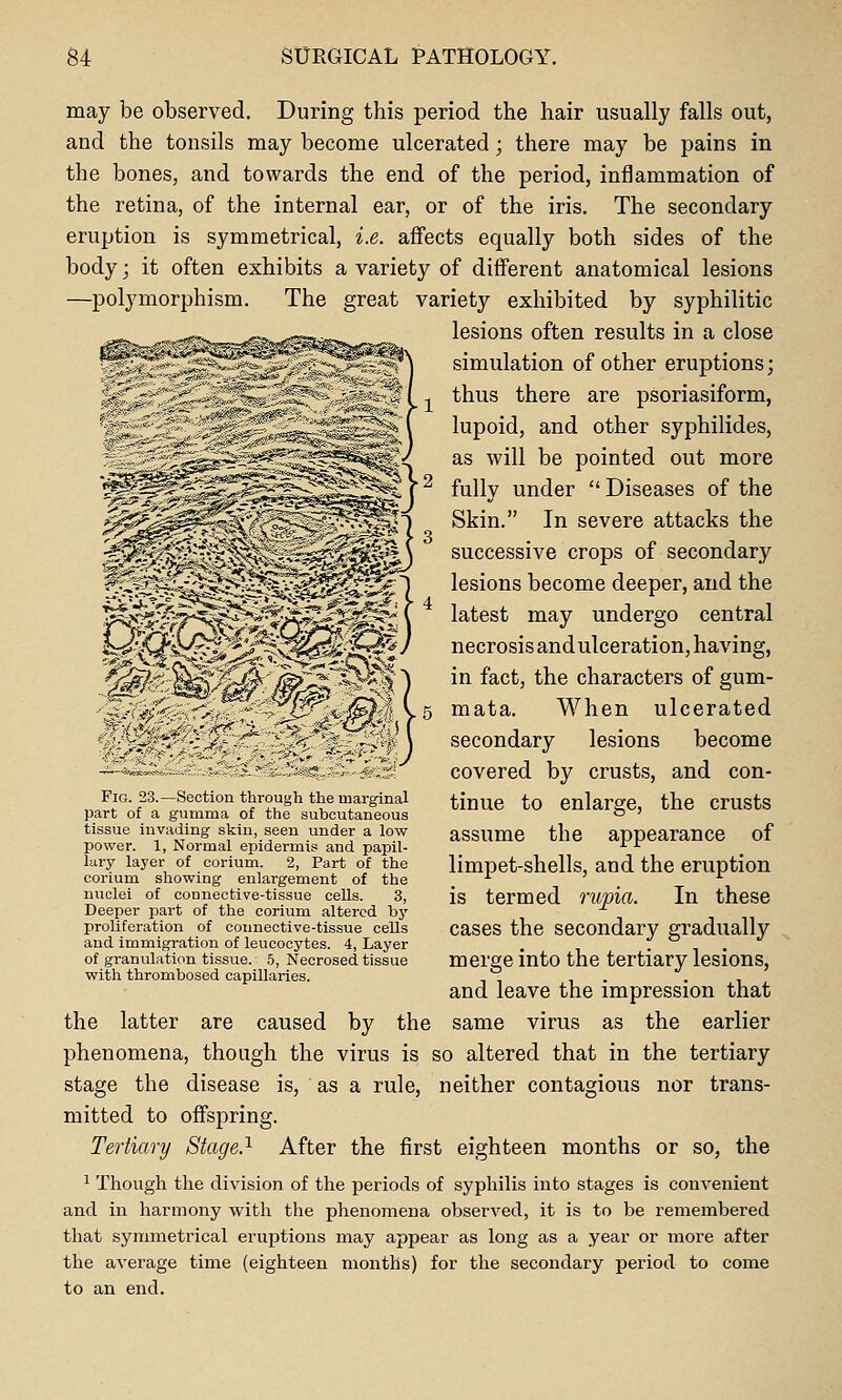 may be observed. During this period the hair usually falls out, and the tonsils may become ulcerated; there may be pains in the bones, and towards the end of the period, inflammation of the retina, of the internal ear, or of the iris. The secondary eruption is symmetrical, i.e. affects equally both sides of the body; it often exhibits a variety of different anatomical lesions —polj'morphism. The great variety exhibited by syphilitic lesions often results in a close simulation of other eruptions; thus there are psoriasiform, lupoid, and other syphilides, as will be pointed out more fully under  Diseases of the Skin. In severe attacks the successive crops of secondary lesions become deeper, and the latest may undergo central necrosis and ulceration, having, in fact, the characters of gum- mata. When ulcerated secondary lesions become covered by crusts, and con- tinue to enlarge, the crusts assume the appearance of limpet-shells, and the eruption is termed rupia. In these cases the secondary gradually merge into the tertiary lesions, and leave the impression that same virus as the earlier ..S!Sj?S^ai,,-^s:i Fig. 23.—Section through the marginal part of a gumma of the subcutaneous tissue invading skin, seen under a low power. 1, Normal epidermis and papil- lary layer of corium. 2, Part of the corium showing enlargement of the nuclei of connective-tissue cells. 3, Deeper part of the corium altered by proliferation of connective-tissue cells and immigration of leucocytes. 4, Layer of granulation tissue. 5, Necrosed tissue witli thrombosed capillaries. the latter are caused by the phenomena, though the virus is so altered that in the tertiary stage the disease is, as a rule, neither contagious nor trans- mitted to offspring. Tertiary Stage.'^ After the first eighteen months or so, the 1 Though the division of the periods of syphilis into stages is convenient and in harmony with the phenomena observed, it is to be remembered that symmetrical eruptions may appear as long as a year or more after the average time (eighteen months) for the secondary period to come to an end.