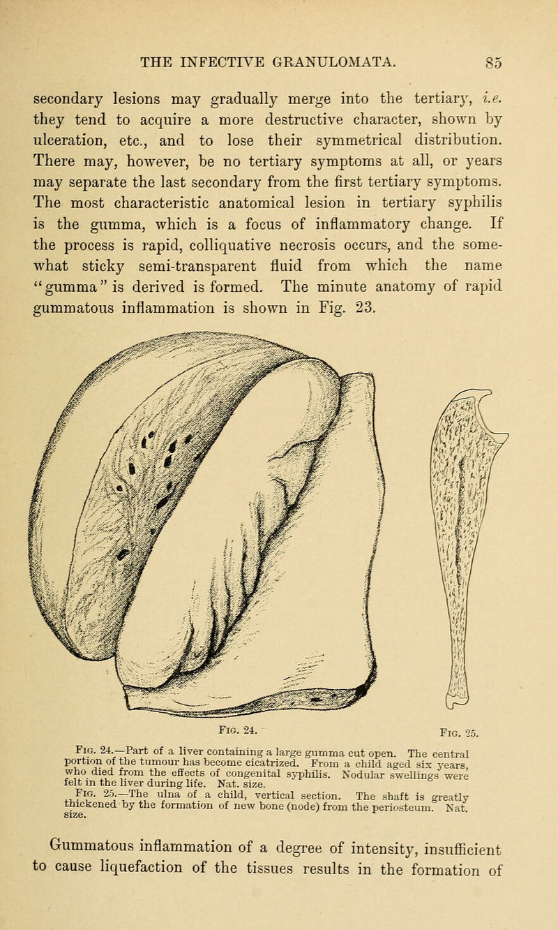 secondary lesions may gradually merge into the tertiary, i.e. they tend to acquire a more destructive character, shown by ulceration, etc., and to lose their symmetrical distribution. There may, however, be no tertiary symptoms at all, or years may separate the last secondary from the first tertiary symptoms. The most characteristic anatomical lesion in tertiary syphilis is the gumma, which is a focus of inflammatory change. If the process is rapid, colliquative necrosis occurs, and the some- what sticky semi-transparent fluid from which the name  gumma is derived is formed. The minute anatomy of rapid gummatous inflammation is shown in Fig. 23. Fig. 24. tJJ Fig. 25. Fig. 24.—Part of a liver containing a large gumma cut open. The central portion of the tumour has become cicatrized. From a child aged six years, who died from the effects of congenital syphilis. Nodular swellings were felt in the liver during life. Nat. size. Fio. 2.5.—The ulna of a child, vertical section. The shaft is greatly thickened by the formation of new bone (node) from the periosteum Nat size. Gummatous inflammation of a degree of intensity, insuflBcient to cause liquefaction of the tissues results in the formation of