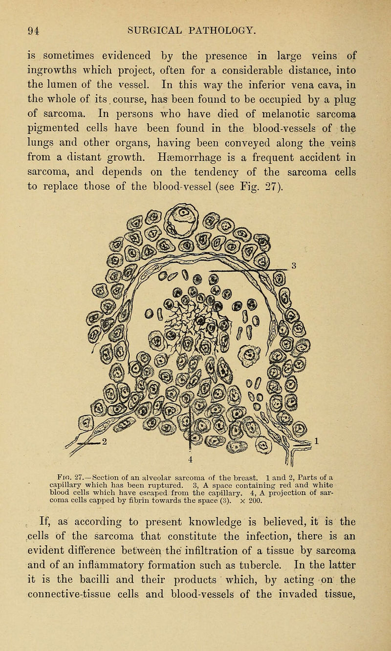 is Sometimes evidenced by the presence in large veins of ingrowths which project, often for a considerable distance, into the lumen of the vessel. In this way the inferior vena cava, in the whole of its. course, has been found to be occupied by a plug of sarcoma. In persons who have died of melanotic sarcoma pigmented cells have been found in the blood-vessels of the lungs and other organs, having been conveyed along the veins from a distant growth. Haemorrhage is a frequent accident in sarcoma, and depends on the tendency of the sarcoma cells to replace those of the blood-vessel (see Fig. 27). Fia. 27.—Section of an alveolar sarcoma of the breast. 1 and 2, Parts of a capillary which has been ruptured. 3, A space containing- red and white blood cells which have escaped from the capillary. 4, A projection of sar- coma cells capped by fibrin towards the space (3). x 200. If, as according to present knowledge is believed, it is the .cells of the sarcoma that constitute the infection, there is an evident difference between the infiltration of a tissue by sarcoma and of an inflammatory formation such as tubercle. In the lattfer it is the bacilli and their products which, by acting on the connective-tissue cells and blood-vessels of the invaded tissue,