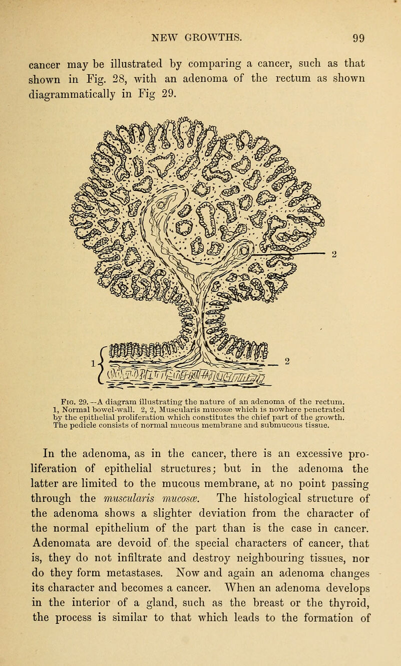 cancer may be illustrated by comparing a cancer, such as that shown in Fig. 28, with an adenoma of the rectum as shown diagrammatically in Fig 29. _ ^^^M^^^^^ummg^ Pig. 29. —A diagram illustrating the nature of an adenoma of the rectum. 1, Normal bowel-wall. 2, 2, Muscularis mucosae which is nowhere penetrated by the epithelial proliferation which constitutes the chief part of the growth. The pedicle consists of normal mucous membrane and submucous tissue. In the adenoma, as in the cancer, there is an excessive pro- liferation of epithelial structures; but in the adenoma the latter are limited to the mucous membrane, at no point passing through the muscularis mucosce. The histological structure of the adenoma shows a slighter deviation from the character of the normal epithelium of the part than is the case in cancer. Adenomata are devoid of the special characters of cancer, that is, they do not infiltrate and destroy neighbouring tissues, nor do they form metastases. Now and again an adenoma changes its character and becomes a cancer. When an adenoma develops in the interior of a gland, such as the breast or the thyroid, the process is similar to that Avhich leads to the formation of