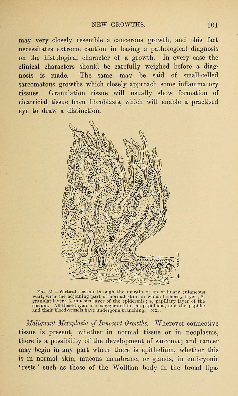 may very closely resemble a cancerous growth, and this fact necessitates extreme caution in basing a pathological diagnosis on the histological character of a growth. In every case the clinical characters should be carefully weighed before a diag- nosis is made. The same may be said of small-celled sarcomatous growths which closel}'' approach some inflammatory tissues. Granulation tissue will usually show formation of cicatricial tissue from fibroblasts, which will enable a practised eye to draw a distinction. Fig. 31.—Vertical sectloa through the margin of an ordinary cutaneous wart, with the adjoining part of normal skin, in which 1= horny layer; 2, granular layer; 3, mucous layer of the epidermis ; 4, papillary layer of the corium. All these layers are exaggerated in the papilloma, and the papillse and their blood-vessels have undergone branching. x25. Malignant Metaplasia of Innocent Growths. Wherever connective tissue is present, whether in normal tissue or in neoplasms, there is a possibility of the development of sarcoma; and cancer may begin in any part where there is epithelium, whether this is in normal skin, mucous membrane, or glands, in embryonic ' rests' such as those of the Wollfian body in the broad liga-