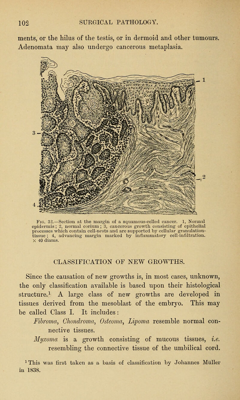 ments, or the hilus of the testis, or in dermoid and other tumours. Adenomata may also undergo cancerous metaplasia. 3- FiG. 32.—Section at the margin of a squamous-celled cancer. 1, Noi-mal epidermis ; 2, normal cerium ; 3, cancerous growth consisting of epithelial processes which contain cell-nests and are supported by cellular granulation- tissue ; 4, advancing margin marked by inflammatory cell-infiltration. X 40 diams. CLASSIFICATION OF NEW GEOWTHS. Since the causation of new growths is, in most cases, unknown, the only classification available is based upon their histological structure.^ A large class of new growths are developed in tissues derived from the mesoblast of the embryo. This may be called Class I. It includes: Fibroma, Chondroma, Osteoma, Lipoma resemble normal con- nective tissues. Myxoma is a growth consisting of mucous tissues, i.e. resembling the connective tissue of the umbilical cord. ^ This was tirst taken as a basis of classification by Johannes Miiller in 1838.