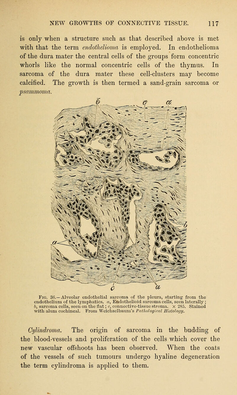 is only when a structure such as that described above is met with that the term endothelioma is employed. In endothelioma of the dura mater the central cells of the groups form concentric whorls like the normal concentric cells of the thymus. In sarcoma of the dura mater these cell-clusters may become calcified. The growth is then termed a sand-grain sarcoma or psammoma. Fig. 36.—Alveolar endothelial sarcoma of the pleura, starting from the endothelium of the lymphatics, a, Endothelioid sarcoma cells, seen laterally ; 6, sarcoma cells, seen on the flat; c, conuective-tissue stroma, x 285. Stained with alum cochineal. From Weichselbaum's Pathological Histology. Cylindroma. The origin of sarcoma in the budding of the blood-vessels and proliferation of the cells which cover the new vascular offshoots has been observed. When the coats of the vessels of such tumours undergo hyaline degeneration the term cylindroma is applied to them.