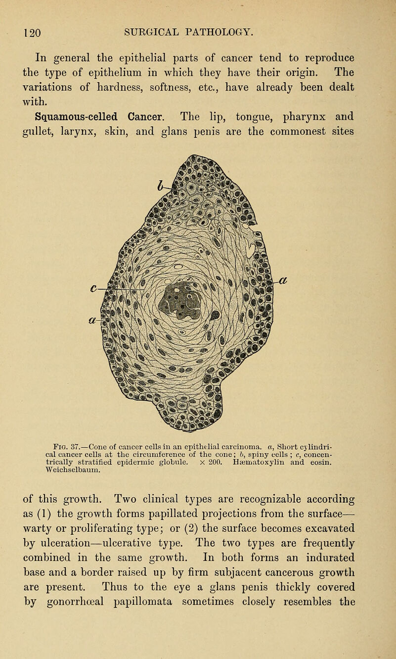 In general the epithelial parts of cancer tend to reproduce the type of epithelium in which they have their origin. The variations of hardness, softness, etc., have already been dealt with. Squamous-celled Cancer. The lip, tongue, pharynx and gullet, larynx, skin, and glans penis are the commonest sites Fig. 37.—Cone of cancer cells in an epithelial carcinoma, a, Short cylindri- cal cancer cells at the circumference of the cone; b, spiny cells ; c, concen- trically stratified epidermic globnle. x 200. I3iematoxylin and eosin. Weichselbaum. of this growth. Two clinical types are recognizable according as (1) the growth forms papillated projections from the surface— warty or proliferating type; or (2) the surface becomes excavated by ulceration—ulcerative type. The two types are frequently combined in the same growth. In both forms an indurated base and a border raised up by firm subjacent cancerous growth are present. Thus to the eye a glans penis thickly covered by gonorrhceal papillomata sometimes closely resembles the