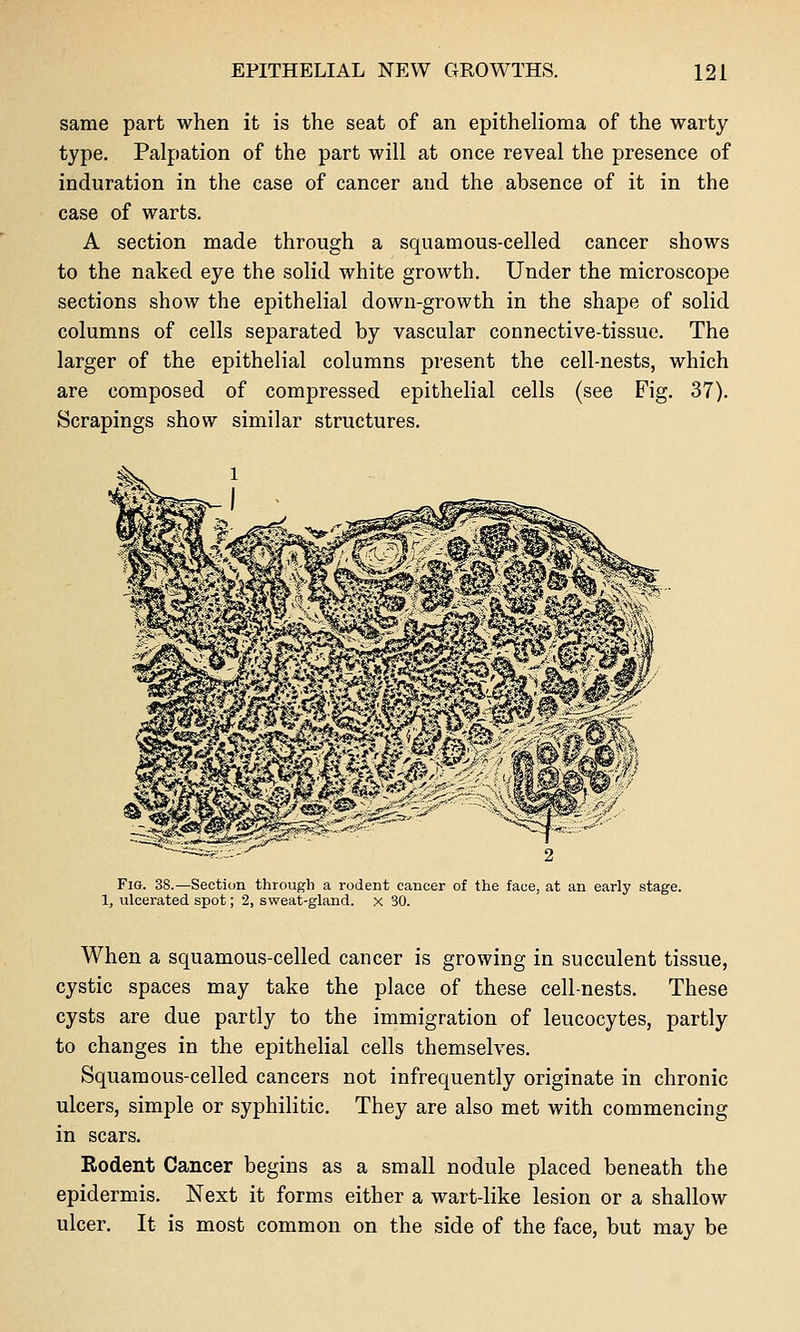 same part when it is the seat of an epithelioma of the warty type. Palpation of the part will at once reveal the presence of induration in the case of cancer and the absence of it in the case of warts. A section made through a squamous-celled cancer shows to the naked eye the solid white growth. Under the microscope sections show the epithelial down-growth in the shape of solid columns of cells separated by vascular connective-tissue. The larger of the epithelial columns present the cell-nests, which are composed of compressed epithelial cells (see Fig. 37). Scrapings show similar structures. Fig. 38.—Section through a rodent cancer of the face, at an early stage. 1, ulcerated spot; 2, sweat-gland, x 30. When a squamous-celled cancer is growing in succulent tissue, cystic spaces may take the place of these cell-nests. These cysts are due partly to the immigration of leucocytes, partly to changes in the epithelial cells themselves. Squamous-celled cancers not infrequently originate in chronic ulcers, simple or syphilitic. They are also met with commencing in scars. Rodent Cancer begins as a small nodule placed beneath the epidermis. Next it forms either a wart-like lesion or a shallow ulcer. It is most common on the side of the face, but may be