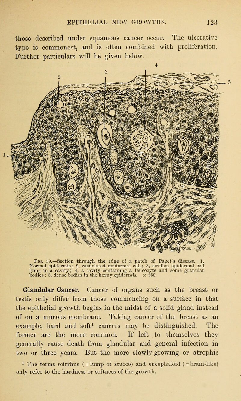 those described under squamous cancer occur. The ulcerative type is commonest, and is often combined with proliferation. Further particulars will be given below. 4 3 —^^^ > ^^^^^^^^ Fig. 39.—Section through the edge of a patch of Paget's disease. 1, Normal eiJidermis ; 2, vacuolated epidermal cell; 3, swollen epidermal cell lyin^ in a cavity ; 4, a cavity containing a leucocyte and some granular bodies ; 5, dense bodies in the horny epidermis, x 250. Grlandular Cancer. Cancer of organs such as the breast or testis only differ from those commencing on a surface in that the epithelial growth begins in the midst of a solid gland instead of on a mucous membrane. Taking cancer of the breast as an example, hard and soft^ cancers may be distinguished. The former are the more common. If left to themselves they generally cause death from glandular and general infection in two or three years. But the more slowly-growing or atrophic 1 The terms scirrhus (=lump of stucco) and encephaloid (== brain-like) only refer to the hardness or softness of the growth.