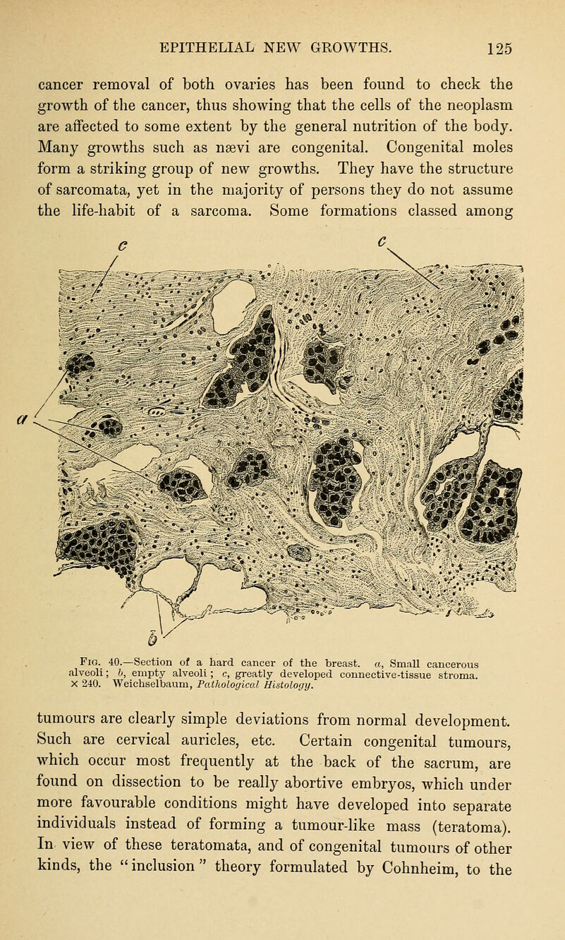 cancer removal of both ovaries has been found to check the growth of tlie cancer, thus showing that the cells of the neoplasm are atfected to some extent by the general nutrition of the body. Many growths such as nsevi are congenital. Congenital moles form a striking group of new growths. They have the structure of sarcomata, yet in the majority of persons they do not assume the life-habit of a sarcoma. Some formations classed among Fig. 40.—Section of a hard cancer of the breast, a, Small cancerous alveoli; h, empty alveoli; c, greatly developed connective-tissue stroma. X 240. Weichselbaum, Pathological Histology. tumours are clearly simple deviations from normal development. Such are cervical auricles, etc. Certain congenital tumours, which occur most frequently at the back of the sacrum, are found on dissection to be really abortive embryos, which under more favourable conditions might have developed into separate individuals instead of forming a tumour-like mass (teratoma). In. view of these teratomata, and of congenital tumours of other kinds, the inclusion theory formulated by Cohnheim, to the