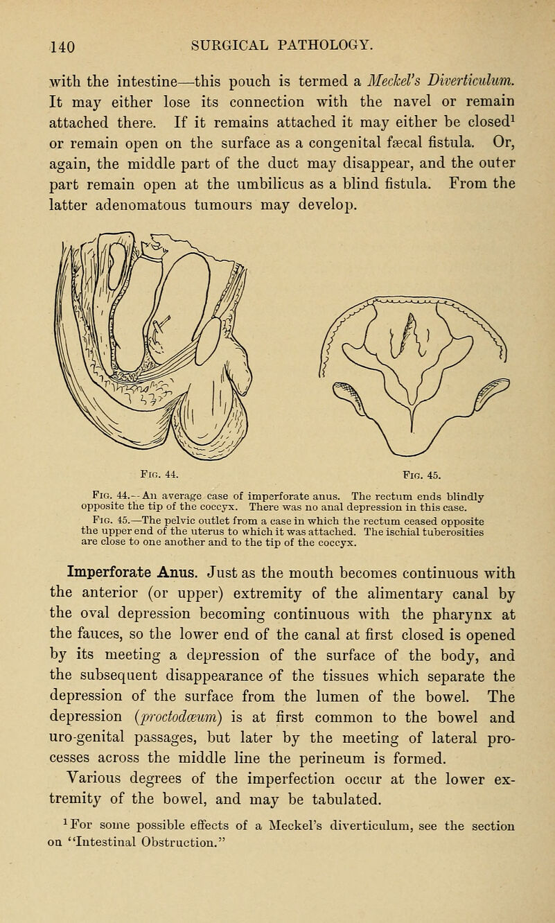 with the intestine—this pouch is termed a Meckel's Diverticulum. It may either lose its connection with the navel or remain attached there. If it remains attached it may either he closed^ or remain open on the surface as a congenital fsecal fistula. Or, again, the middle part of the duct may disappear, and the outer part remain open at the umbilicus as a blind fistula. From the latter adenomatous tumours may develop. Fig. 44. Fig. 45. Fig. 44.—An average case of imperforate anus. The rectum ends blindly opposite the tip of the coccyx. There was no anal depression in this case. Fig. 45.—The pelvic outlet from a case in which the rectum ceased opposite the upper end of the uterus to which it was attached. The ischial tuberosities are close to one another and to the tip of the coccyx. Imperforate Anus. Just as the mouth becomes continuous with the anterior (or upper) extremity of the alimentary canal by the oval depression becoming continuous with the pharynx at the fauces, so the lower end of the canal at first closed is opened by its meeting a depression of the surface of the body, and the subsequent disappearance of the tissues which separate the depression of the surface from the lumen of the bowel. The depression (p-ododceum) is at first common to the bowel and uro-genital passages, but later by the meeting of lateral pro- cesses across the middle line the perineum is formed. Various degrees of the imperfection occur at the lower ex- tremity of the bowel, and may be tabulated. ^For some possible effects of a Meckel's diverticulum, see the sectioii OQ Intestinal Obstruction.