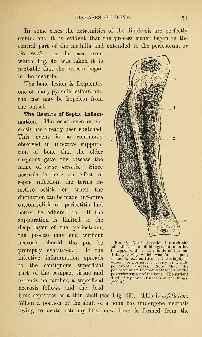 In some cases the extremities of the diaphysis are perfectly sound, and it is evident that the process either began in the central part of the medulla and extended to the periosteum or vice versa. In the case from which Fig. 48 was taken it is probable that the process began in the medulla. The bone lesion is frequently one of many pyaemic lesions, and the case may be hopeless from the outset. The Results of Septic Inflam- mation. The occurrence of ne- crosis has already been sketched. This event is so commonly observed in infective suppura- tion of bone that the older surgeons gave the disease the name of acute necrosis. Since necrosis is here an effect of septic infection, the terms in- fective ostitis or, when the distinction can be made, infective osteomyelitis or periostitis had better be adhered to. If the suppuration is limited to the deep layer of the periosteum, the process may end without pus be If the spreads necrosis, should the promptly evacuated. infective inflammation to the contiguous superficial part of the compact tissue and extends no farther, a superficial necrosis follows and the dead bone separates as a thin shell (see Fig. 49). This is exfoliation. When a portion of the shaft of a bone has undergone necrosis owing to acute osteomyelitis, new bone is formed from the Pig. 48.—Vertical section througli the left tibia of a child aged 10 months. 1, Upper end of ; 2, middle of the me- dullary cavity which was full of pus ; 3 and 4, extremities of the diaphysis which are normal; 5, cavity of a sub- periosteal abscess. Note that the periosteum still remains attached at the posterior aspect of the bone. The patient died of pysemic abscesses of the lungs. (229 B.)