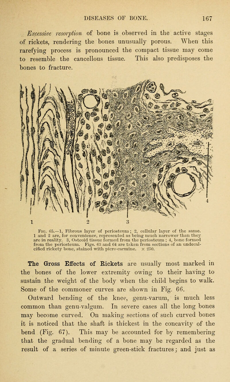 Excessive resorption of bone is observed in the active stages of rickets, rendering the bones unusually porous. When this rarefying process is pronounced the compact tissue may come to resemble the cancellous tissue. This also predisposes the bones to fracture. Fig. 65.—1, Fibrous layer of periosteum ; 2, cellular layer of the same. 1 and 2 are, for convenience, represented as being much narrower than they are in reality. 3, Osteoid tissue formed from the periosteum ; 4, bone formed from the periosteum. Figs. 63 and 64 are taken from sections of an undecal- cifled rickety bone, stained with picro-carmine. x 250. The Gross Effects of Rickets are usually most marked in the bones of the lower extremity owing to their having to sustain the weight of the body when the child begins to walk. Some of the commoner curves are shown in Fig. 66. Outward bending of the knee, genu-varura, is much less common than genu-valgum. In severe cases all the long bones may become curved. On making sections of such curved bones it is noticed that the shaft is thickest in the concavity of the bend (Fig. 67). This may be accounted for by remembering that the gradual bending of a bone may be regarded as the result of a series of minute green-stick fractures; and just as
