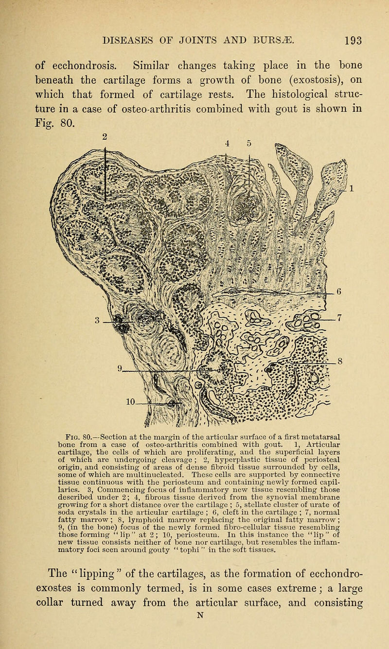 of ecchondrosis. Similar changes taking place in the bone beneath the cartilage forms a growth of bone (exostosis), on which that formed of cartilage rests. The histological struc- ture in a case of osteo-arthritis combined with gout is shown in Fig. 80. 2 FiQ. 80.—Section at the margin of the articular surface of a first metatarsal bone from a case of osteo-arthritis combined with gout. 1, Articular cartilage, the cells of which are proliferating, and the superficial layers of which are undergoing cleavage; 2, hyperplastic tissue of periosteal origin, and consisting of areas of dense fibroid tissue surrounded by cells, some of which are multinucleated. These cells are supported by connective tissue continuous with the periosteum and containing newly formed capil- laries. 3, Commencing focus of inflammatory new tissue resembling those described under 2; 4, fibrous tissue derived from the synovial membrane growing for a short distance over the cartilage ; 5, stellate cluster of urate of soda ci-ystals in the articular cartilage ; 6, cleft in the cartilage ; 7, normal fatty marrow; S, lymphoid marrow replacing the original fatty marrow; 9, (in the bone) focus of the newly formed fibro-cellular tissue resembling those forming lip at 2; 10, periosteum. In this instance the lip of new tissue consists neither of bone nor cartilage, but resembles the inflam- matory foci seen around gouty tophi in the soft tissues. The lipping of the cartilages, as the formation of ecchondro- exostes is commonly termed, is in some cases extreme; a large collar turned away from the articular surface, and consisting N