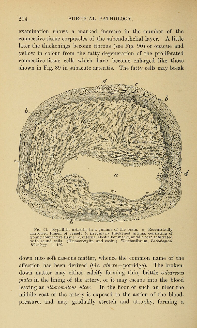 examination shows a marked increase in the -number of the connective-tissue corpuscles of the subendothelial layer. A little later the thickenings become fibrous (see Fig. 90) or opaque and yellow in colour from the fatty degeneration of the proliferated connective-tissue cells which have become enlarged like those shown in Fig. 89 in subacute arteritis. The fatty cells may break Pig. 91.—Syphilitic arteritis in a gumma of the brain, a, Eccentrically narrowed lumen of vessel; h, irregularly thickened iutima, consisting of young connective tissue ; c, internal elastic lamina; d, middle coat, infiltrated with round cells. (Haematoxylin and eosin.) Weichselbaum, Pathological Histology, x 160. down into soft caseous matter, whence the common name of the affection has been derived (Gr. a^Aere = porridge). The broken- down matter may either calcify forming thin, brittle calcareous plates in the lining of the artery, or it may escape into the blood leaving an atheromatous ulcer. In the floor of such an ulcer the middle coat of the artery is exposed to the action of the blood- pressure, and may gradually stretch and atrophy, forming a