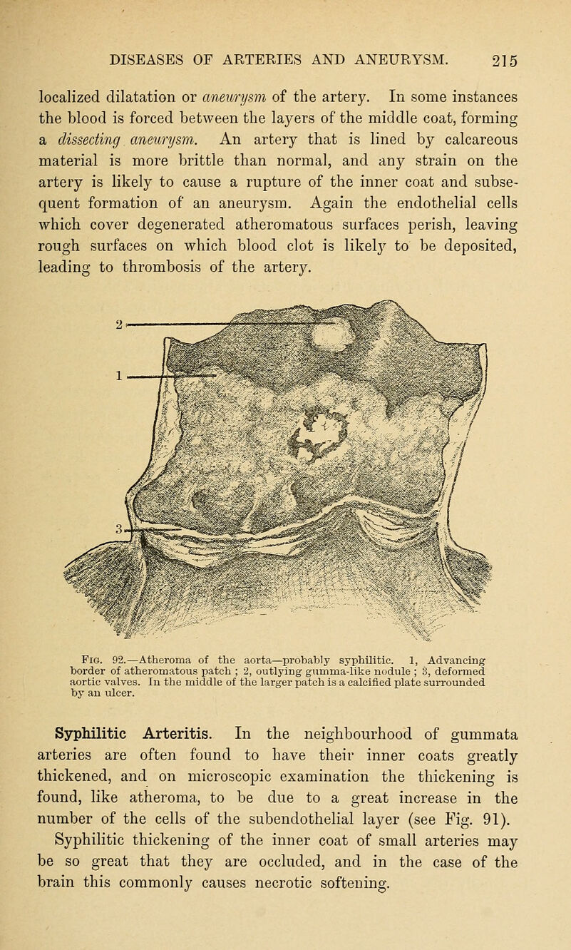 localized dilatation or aneurysm of the artery. In some instances the blood is forced between the layers of the middle coat, forming a dissecting aneunjsm. An artery that is lined by calcareous material is more brittle than normal, and any strain on the artery is likely to cause a rupture of the inner coat and subse- quent formation of an aneurysm. Again the endothelial cells which cover degenerated atheromatous surfaces perish, leaving rough surfaces on which blood clot is likely to be deposited, leading to thrombosis of the artery. ^■ * </ Fig. 92.—Atheroma of the aorta—probably syphilitic. 1, Advancing border of atheromatous patch ; 2, outlying gumma-like nodule ; 3, deformed aortic valves. In the middle of the larger patch is a calcified plate surrounded by an ulcer. SypMlitic Arteritis. In the neighbourhood of gummata arteries are often found to have their inner coats greatly thickened, and on microscopic examination the thickening is found, like atheroma, to be due to a great increase in the number of the cells of the subendothelial layer (see Fig. 91). Syphilitic thickening of the inner coat of small arteries may be so great that they are occluded, and in the case of the brain this commonly causes necrotic softening.