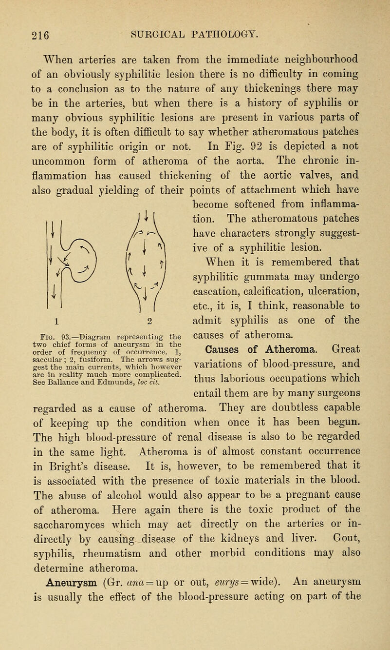 When arteries are taken from the immediate neighbourhood of an obviously syphilitic lesion there is no difficulty in coming to a conclusion as to the nature of any thickenings there may be in the arteries, but when there is a history of syphilis or many obvious syphilitic lesions are present in various parts of the body, it is often difficult to say whether atheromatous patches are of syphilitic origin or not. In Fig. 92 is depicted a not uncommon form of atheroma of the aorta. The chronic in- flammation has caused thickening of the aortic valves, and also gradual yielding of their points of attachment which have become softened from inflamma- tion. The atheromatous patches have characters strongly suggest- ive of a syphilitic lesion. When it is remembered that syphilitic gummata may undergo caseation, calcification, ulceration, etc., it is, I think, reasonable to 1 2 admit syphilis as one of the Fig. 93.—Diagram representing the CaUSeS of atheroma, two chief forms of aneurysm in the -, # A +V, P f order of frequency of occurrence. 1, OaUSeS 01 Atlieroma. IxreaC saccular; 2, fusiform. The arrows sug- • j.- „ e l,l„„J . „•„« ^-^J gest the mkm currents, which howevir Variations ot blood-prcssure, and ire^alwlnTEdmTnds.rc^!'^'*''- thuS kborioUS OCCUpatioUS which entail them are bj^ many surgeons regarded as a cause of atheroma. They are doubtless capable of keeping up the condition when once it has been begun. The high blood-pressure of renal disease is also to be regarded in the same light. Atheroma is of almost constant occurrence in Bright's disease. It is, however, to be remembered that it is associated with the presence of toxic materials in the blood. The abuse of alcohol would also appear to be a pregnant cause of atheroma. Here again there is the toxic product of the saccharomyces which may act directly on the arteries or in- directly by causing ^disease of the kidneys and liver. Gout, syphilis, rheumatism and other morbid conditions may also determine atheroma. Aneurysm (Gr. fma = up or out, eti,rys = wide). An aneurysm is usually the efiect of the blood-pressure acting on part of the