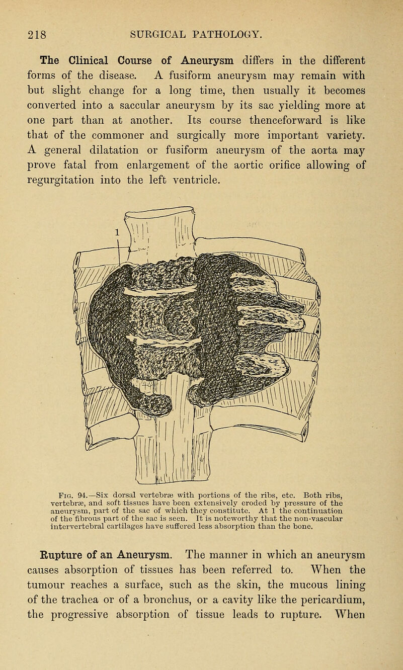 The Clinical Course of Aneurysm differs in the different forms of the disease. A fusiform aneurysm may remain with but slight change for a long time, then usually it becomes converted into a saccular aneurysm by its sac yielding more at one part than at another. Its course thenceforward is like that of the commoner and surgically more important variety. A general dilatation or fusiform aneurysm of the aorta may prove fatal from enlargement of the aortic orifice allowing of regurgitation into the left ventricle. Fig. 94.—Six dorsal vertebrse with portions of the ribs, etc. Both ribs, vertebrse, and soft tissues have been extensively eroded by pressure of the anevirysm, part of the sac of which they constitute. At 1 the continuation of the fibrous part of the sac is seen. It is noteworthy tliat the non-vascular intervertebral cartilages have suffered less absorption than the bone. Rupture of an Aneurysm. The manner in which an aneurysm causes absorption of tissues has been referred to. When the tumour reaches a surface, such as the skin, the mucous lining of the trachea or of a bronchus, or a cavity like the pericardium, the progressive absorption of tissue leads to rupture. When