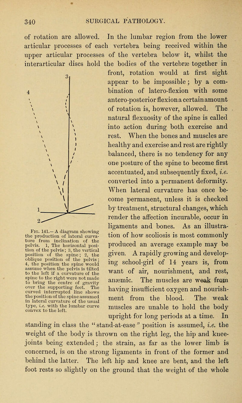 of rotation are allowed. In the lumbar region from the lower articular processes of each vertebra being received within the upper articular processes of the vertebra below it, whilst the interarticular discs hold the bodies of the vertebrae together in front, rotation would at first sight appear to be impossible; by a com- bination of latero-flexion with some antero-posterior flexion a certain amount of rotation is, however, allowed. The natural flexuosity of the spine is called into action during both exercise and rest. When the bones and muscles are healthy and exercise and rest are rightly balanced, there is no tendency for any one posture of the spine to become first accentuated, and subsequently fixed, i.e. converted into a permanent deformity. When lateral curvature has once be- come permanent, unless it is checked by treatment, structural changes, which render the aff'ection incurable, occur in ligaments and bones. As an illustra- tion of how scoliosis is most commonly produced an average example may be given, A rapidly growing and develop- ing school-girl of 14 years is, from want of air, nourishment, and rest, anaemic. The muscles are weak from having insufficient oxygen and nourish- ment from the blood. The weak muscles are unable to hold the body upright for long periods at a time. In standing in class the  stand-at-ease  position is assumed, i.e. the weight of the body is thrown on the right leg, the hip and knee- joints being extended; the strain, as far as the lower limb is concerned, is on the strong ligaments in front of the former and behind the latter. The left hip and knee are bent, and the left foot rests so slightly on the ground that the weight of the whole Fig. 141.—A diagi-am showing the production of lateral curva- ture from inclination of the pelvis. 1, The horizontal posi- tion of the pelvis; 3, the vertical position of the spine; 2, the oblique position of the pelvis ; 4, the position the spine would assume when the pelvis is tilted to the left if a curvature of the spine to the right were not made to bring the centre of gravity over the supporting feet. The curved interrupted line shows the position of the spine assumed in lateral curvature of the usual type, i.e. with the lumbar curve convex to the left.