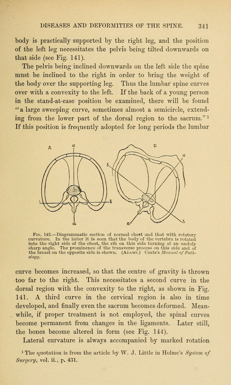 body is practically supported by the right leg, and the position of the left leg necessitates the pelvis being tilted dowmvards on that side (see Fig. 141). The pelvis being inclined downwards on the left side the spine must be inclined to the right in order to bring the weight of the body over the supporting leg. Thus the lumbar spine curves over with a convexity to the left. If the back of a young person in the stand-at-ease position be examined, there will be found a large sweeping curve, sometimes almost a semicircle, extend- ing from the lower part of the dorsal region to the sacrum. ^ If this position is frequently adopted for long periods the lumbar Fro. 142.—Diagrammatic section of nomial chest and that with rotatory curvature. In the latter it is seen that the body of the vertebra is rotated into the right side of the chest, the rib on this side turning at an undulp sharp angle. The prominence of the transverse process on this side and of the breast on the opposite side is shown. (Adams.) Coats's Manual of Path- ology. curve becomes increased, so that the centre of gravity is thrown too far to the right. This necessitates a second curve in the dorsal region with the convexity to the right, as shown in Fig. 141. A third curve in the cervical region is also in time developed, and finally even the sacrum becomes deformed. Mean- while, if proper treatment is not employed, the spinal curves become permanent from changes in the ligaments. Later still, the bones become altered in form (see Fig. 144). Lateral curvature is always accompanied by marked rotation ^ The quotation is from the article by W. J. Little iu Holme's System of Siirgery, vol. ii., p. 4.31.