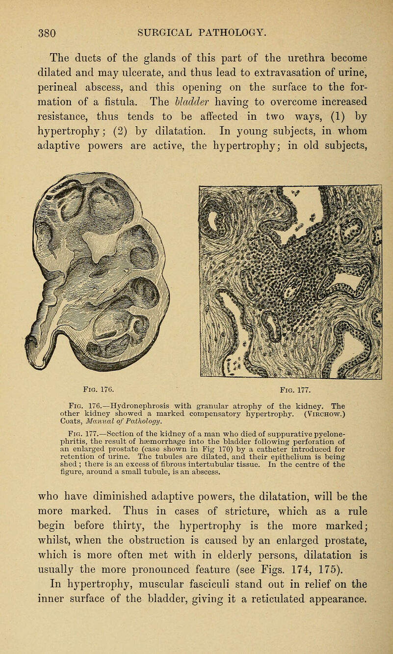 The ducts of the glands of this part of the urethra become dilated and may ulcerate, and thus lead to extravasation of urine, perineal abscess, and this opening on the surface to the for- mation of a fistula. The bladder having to overcome increased resistance, thus tends to be affected in two ways, (1) by hypertrophy; (2) by dilatation. In young subjects, in whom adaptive powers are active, the hypertrophy; in old subjects, Fig. 17e. Fig. 177. Fig. 176.—Hydronephrosis with granular atrophy of the kidney. The other kidney showed a marked compensatory hypertrophy. (Viechow.) Coats, Manual of Pathology. Fio. 177.—Section of the kidney of a man who died of suppurative pyelone- phritis, the result of hsemorrhage into the bladder following perforation of an enlarged prostate (case shown in Fig 170) by a catheter introduced for retention of urine. The tubules are dilated, and their epithelium is being shed ; there is an excess of fibrous intertubular tissue. In the centre of the figure, around a small tubule, is an abscess. who have diminished adaptive powers, the dilatation, will be the more marked. Thus in cases of stricture, which as a rule begin before thirty, the hypertrophy is the more marked; whilst, when the obstruction is caused by an enlarged prostate, which is more often met with in elderly persons, dilatation is usually the more pronounced feature (see Figs. 174, 175). In hypertrophy, muscular fasciculi stand out in relief on the inner surface of the bladder, giving it a reticulated appearance.