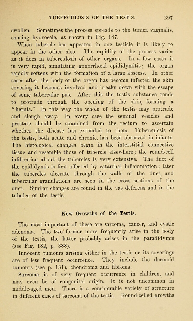 swollen. Sometimes the process spreads to the tunica vaginalis, causing hydrocele, as shown in Fig. 187. When tubercle has appeared in one testicle it is likely to appear in the other also. The rapidity of the process varies as it does in tuberculosis of other organs. In a few cases it is very rapid, simulating gonorrhoea! epididymitis; the organ rapidly softens with the formation of a large abscess. In other cases after the body of the organ has become infected the skin covering it becomes involved and breaks down with the escape of some tubercular pus. After this the testis substance tends to protrude through the opening of the skin, forming a hernia. In this way the whole of the testis may protrude and slough away. In every case the seminal vesicles and prostate should be examined from the rectum to ascertain whether the disease has extended to them. Tuberculosis of the testis, both acute and chronic, has been observed in infants. The histological changes begin in the interstitial connective tissue and resemble those of tubercle elsewhere; the round-cell infiltration about the tubercles is very extensive. The duct of the epididymis is first affected by catarrhal inflammation; later the tubercles ulcerate through the walls of the duct, and tubercular granulations are seen in the cross sections of the duct. Similar changes are found in the vas deferens and in the tubules of the testis. New Growths of the Testis. The most important of these are sarcoma, cancer, and cystic adenoma. The two former more frequently arise in the body of the testis, the latter probably arises in the paradidymis (see Fig. 182, p. 388). Innocent tumours arising either in the testis or its coverings are of less frequent occurrence. They include the dermoid tumours (see p. 131), chondroma and fibroma. Sarcoma is of very frequent occurrence in children, and may even be of congenital origin. It is not uncommon in middle-aged men. There is a considerable variety of structure in different cases of sarcoma of the testis. Round-celled growths