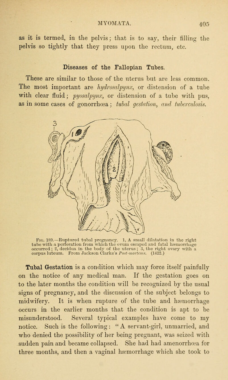 as it is termed, in the pelvis; that is to say, their fiUing the pelvis so tightly that they press upon the rectum, etc. Diseases of the Fallopian Tubes. These are similar to those of the uterus but are less common. The most important are hydromljpynx, or distension of a tube with clear fluid; 'pyosalpjnoi, or distension of a tube with pus, as in some cases of gonorrhoea; tubal gestation, and tuberculosis. Fig. 1S9.—Ruptured tubal pregnancy. 1, A small dilatation in the right tube with a perforation from which the ovum escaped and fatal hfemorrhage occurred; 2, decidua in the body of the uterus ; 3, the right ovary with a corpus luteum. From Jackson Clarke's Post-mortems. (1422.) Tubal Gestation is a condition which may force itself painfully on the notice of any medical man. If the gestation goes on to the later months the condition will be recognized by the usual signs of pregnancy, and the discussion of the subject belongs to midwifery. It is when rupture of the tube and haemorrhage occurs in the earlier months that the condition is apt to be misunderstood. Several typical examples have come to my notice. Such is the following :  A servant-girl, unmarried, and who denied the possibility of her being pregnant, was seized with sudden pain and became collapsed. She had had amenorrhea for three months, and then a vaginal haemorrhage which she took to