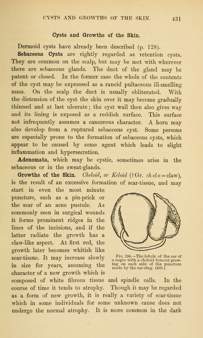 Cysts and Growths of the Skin, Dermoid cysts have already been described (p. 128). Sebaceous Cysts are rightly regarded as retention cysts. They are common on the scalp, but may be met with wherever there are sebaceous glands. The duct of the gland may be patent or closed. In the former case the whole of the contents of the cyst may be expressed as a rancid pultaceous ill-smelling mass. On the scalp the duct is usually obliterated. With the distension of the cyst the skin over it may become gradually thinned and at last ulcerate; the cyst wall then also gives way and its lining is exposed as a reddish surface. This surface not infrequently assumes a cancerous character. A horn may also develop from a ruptured sebaceous cyst. Some persons are especially prone to the formation of sebaceous cysts, which appear to be caused by some agent which leads to slight inflammation and hypersecretion. Adenomata, which may be cystic, sometimes arise in the sebaceous or in the sweat-glands. Growths of the Skin. Cheloid, or Keloid (1 Gr. ch-el-e = claw), is the result of an excessive formation of scar-tissue, and may start in even the most minute puncture, such as a pin-prick or the scar of an acne pustule. As commonly seen in surgical wounds it forms prominent ridges in the lines of the incisions, and if the latter radiate the growth has a claw-like aspect. At first red, the growth later becomes whitish like scar-tissue. It may increase slowly a ni^^o IVa^chitw tlour ^'ow' in size for years, assuming the SfdeVthe eaj^ring. (* 9.f'=' character of a new growth which is composed of white fibrous tissue and spindle cells. In the course of time it tends to atrophy. Though it may be regarded as a form of new growth, it is really a variety of scar-tissue which in some individuals for some unknown cause does not undergo the normal atrophy. It is more common in the dark