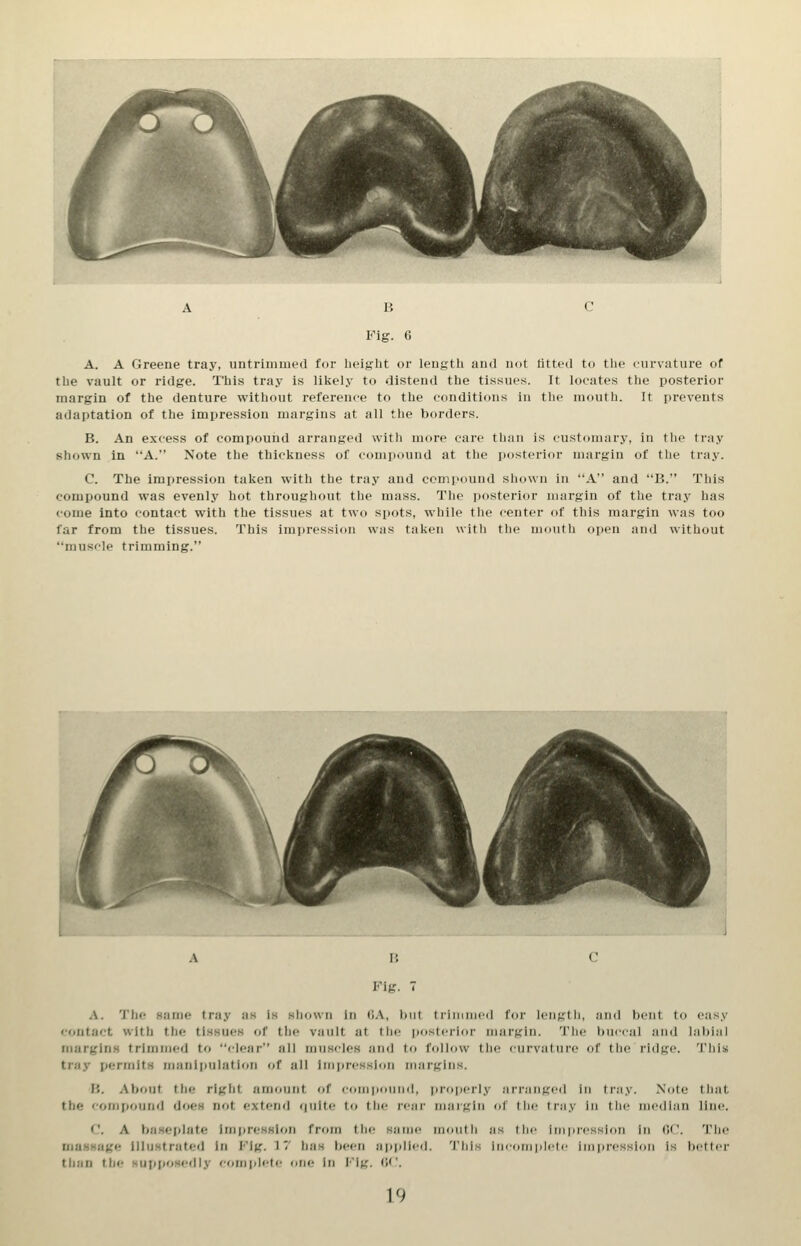 A. A Greene tray, untrimmed for lielglit or length and not tittt'd to tlie curvature of tbe vault or ridge. This tray is likely to distend the tissues. It locates the posterior margin of the denture without reference to the conditions in the mouth. It prevents adaptation of the impression margins at all the borders. B. An excess of compound arranged with more care tliaii is custoin.-iry, in the tray shown in A. Note the thickness of compound at the posterior margin of the trny. C. The impression taken with the tray and compound shown in A and B. Tiiis compound was evenly hot throughout the mass. The posterior margin of the tray has come into contact with the tissues at two spots, while the center of this margin was too far from the tissues. This iniijression was taken witli the mouth open and without muscle trimming. Fig. 7 A. The same tray as is Hhown in OA, but trimmed for length, and bent to easy contact with the tisHues of the vault at ttie posterior margin. The buccal and labial tnargins trimmed to clear all muscles and to follow tli(! curvafui-e oC (lie ridge. 'I'his tray permits maniiiulation of all lmt)resslon margins. B. About the right amount of (•om|)ouMd, projierly arranged in tray. Note tliat tbe compound does not extend rjulte to tlie rear margin of tlie tray iu tlie median line. C A basefilate Imiiresslon from the same mouth as the irnpiessioii In fiC. The DiaMHage Illustrated In i'lg. 17 has been applied. This inroiiiiilcic iiiipicssiou is better than the supposerlly comidete one in l''lg. (!<'.