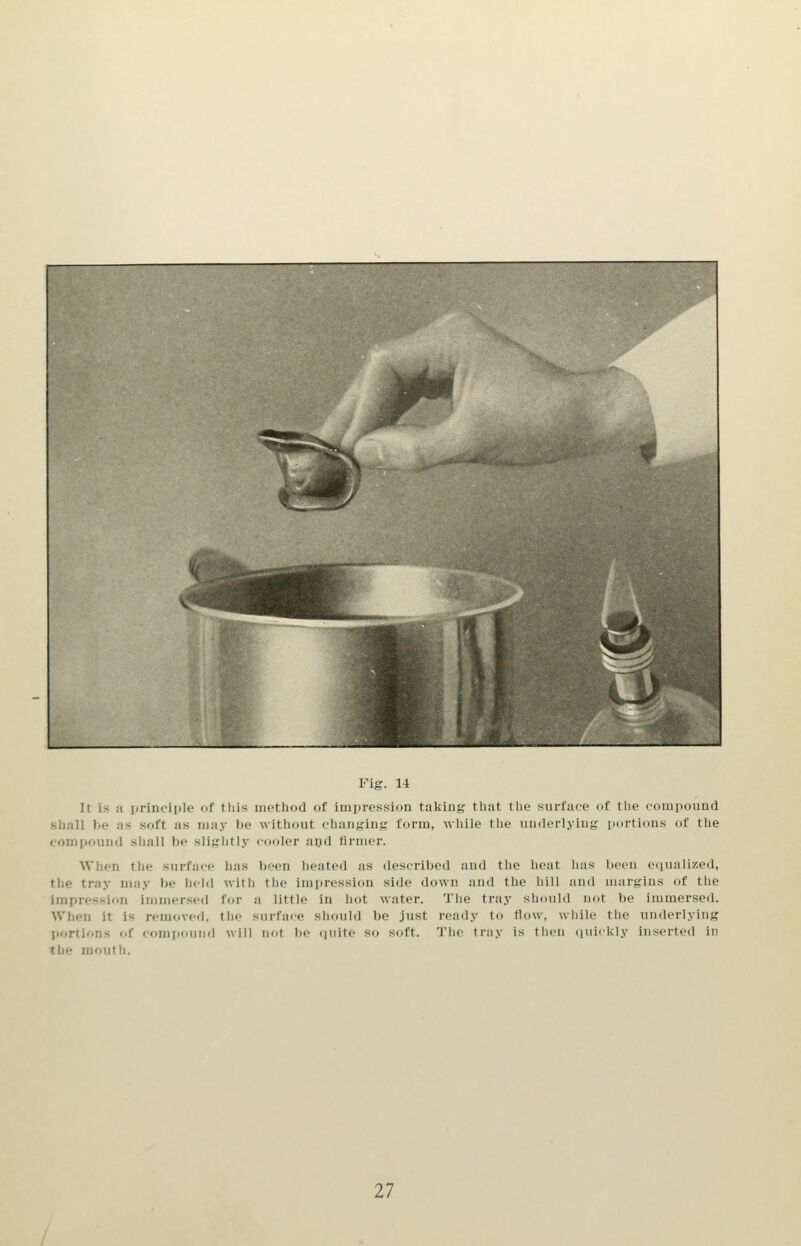 Fig. 1-i It is a principle of tliis method of Impression taking tbat the surface of the compound shall be as soft as may be without changin.i; form, while the underlying portions of the compound shall be slightly cooler apd firmer. When the surface has been heated as described and the heat has been equalized, the tray may be held with the impression side down and the hill and margins of the innpression immersed for a little in hot water. The tray should not be immersed. AVhen it is removed, the surface should be just ready to flow, while the underlying portions of compound will not be (|uite so soft. The tray is then quickly inserted in the mouth.