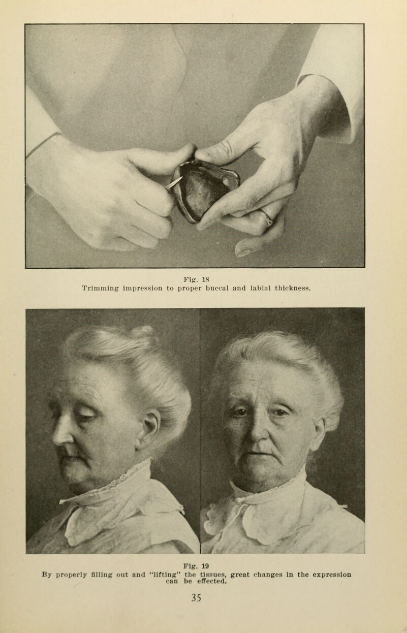 Trimming impression to proper buccal and labial thickness. Fl(?. 19 By properly flllln;? out and llftInK the tlHsues, great changes In the expression can be effected.