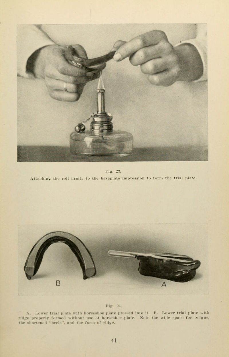 Attaching tlie roll tiniily to the baseplate iiiiiiressidii t<< I'onn the trial plate. I'ig. •_'!. A. Lower trial jilato with horseshoe phite pressed into it. I!. Lower trial plate with ridge properly forilU'd without use of liorseshoe plati>. Note the wide space lor tonmic, the shortened heels, and the Corni of ridge.
