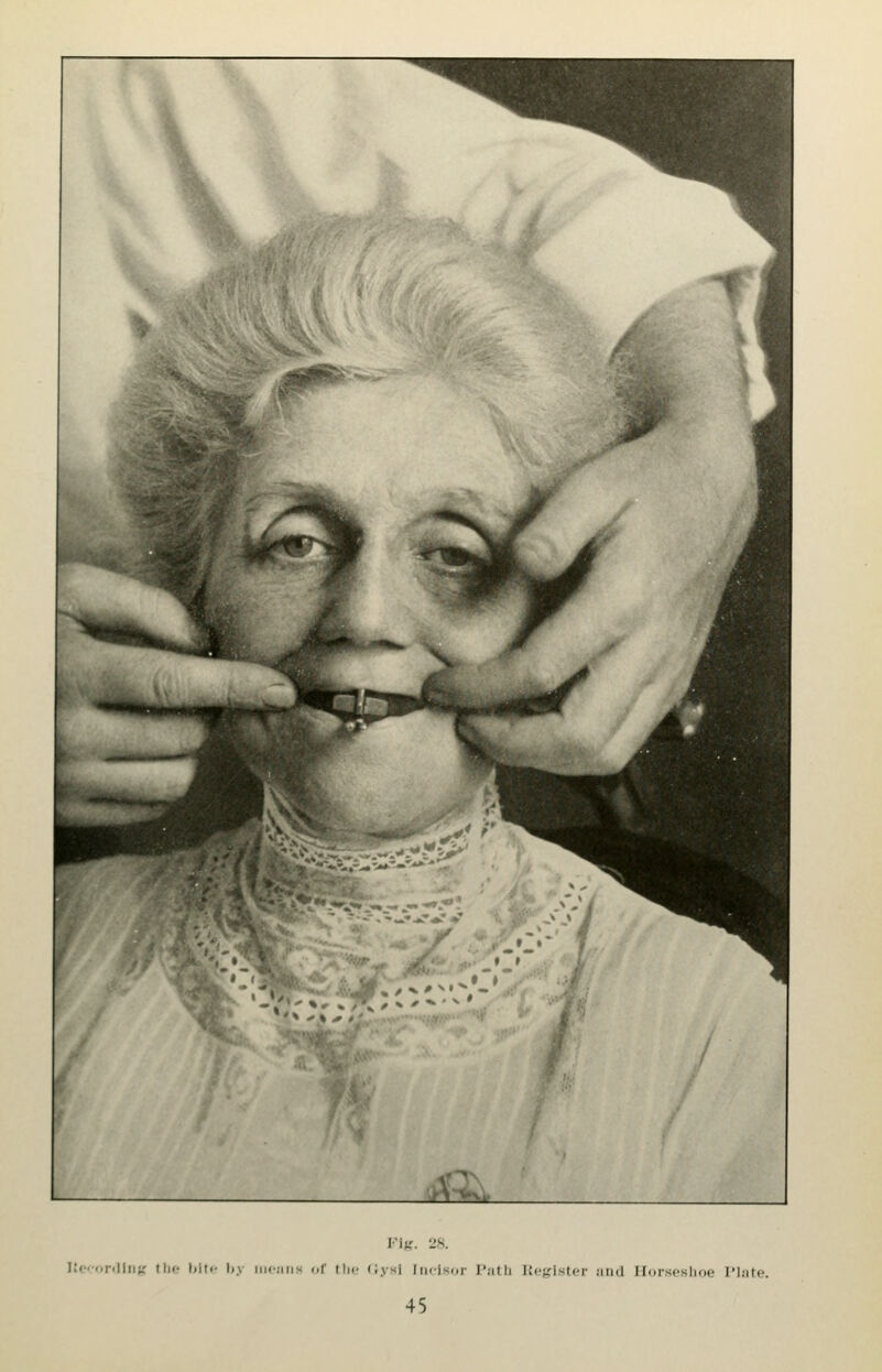 liO'-onlllig the; l»itr. I)y iiic;iiis of tin- (Jysl Iii<-lsi>r riitli Iti-;,'istcr aud Ilorscslioe J'late.