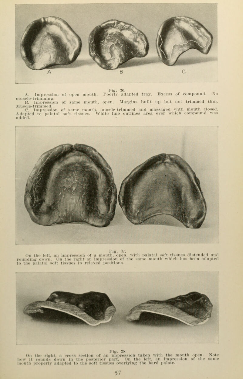 A. Impression of open nnnith. Poorly adapted tray. Excess of compound. No muscle-trimming. B. Impression of same mouth, open. Margins built up but not trimmed thin. Muscle-trimmed. C. Impression of same mouth, muscle-trimmed and massaged with mouth closed. Adapted to palatal soft tissues. White line outlines area over which compound was added. Fig. 37. On the left, an impression df ;i iiicnith, open, with p;il;it;il si.rt tissues disteinhMl an rounding down. On the rigid .-in iiiipi-cssion of tlie same iiKuiih \\iii<-li lias Ijeeii ad.ipti to the i»alatal soft tissues in relaxed pusitidus. Fig. ..8. On tlie rigid, a cpohh Hpcfion of an inii)ressIon taken wltli tlie nioutli open. Note Unw It r<>nn<lH down In tlie posterior part. On tiie left, an impression of the same mouth properly adapted to the soft tissues overlying tlie hard palate.