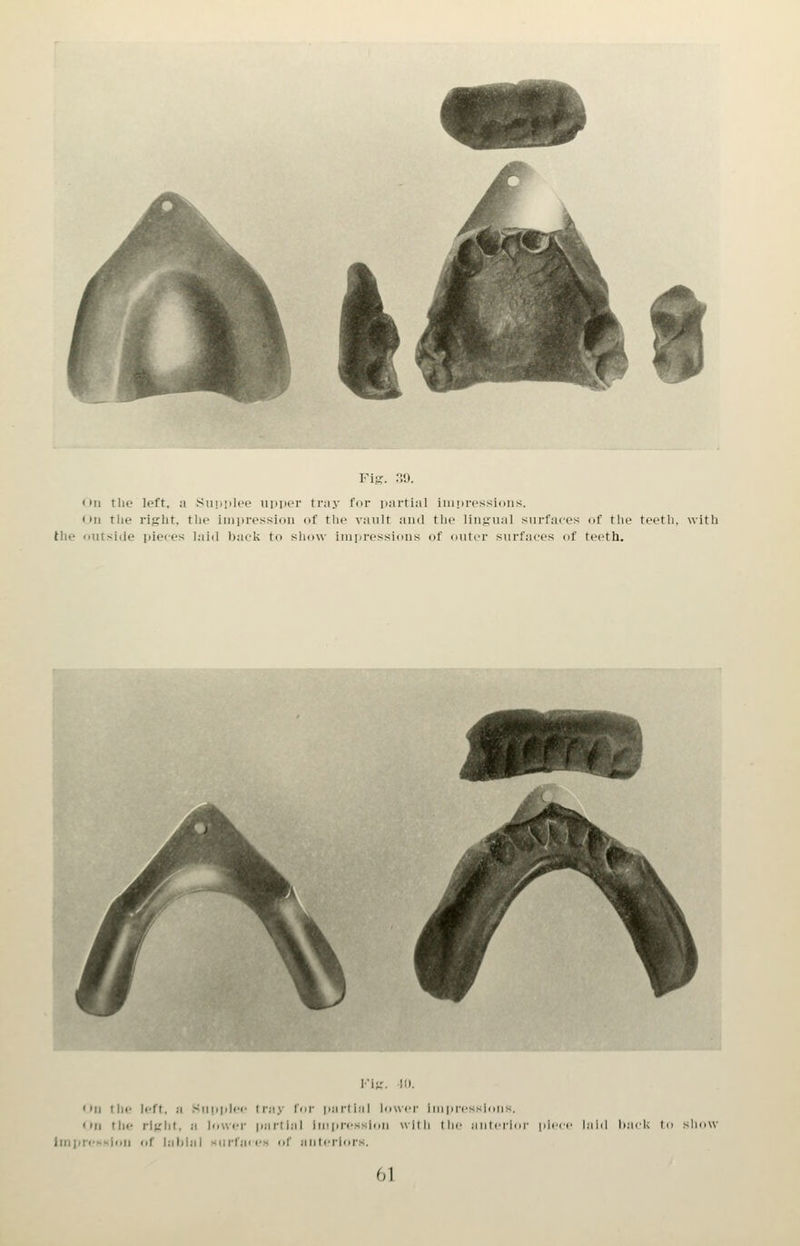 < »n the left, a Siipiih'c iinper tray for jiartial innircssioiis. (til tlie rigrbt. the iniiiressidii of the vault and the lingual surfaces of the teeth, with the outside pieces laid back to show impressions of outer surfaces of teeth. fiVKxaJv^sarviJWii.'aMiimzmmmiUMai-Wf-t-i.:. Fig. 10. • Ill (lie left, a Sii|iplec Iray for parliaj lovscr iinpicssions. On tin- rlglit. a lower partial iin|iressloii v\ilh I he aulciior pii linprefixloii (if labial siirface.x of antcrlors. laid b.'udi to show