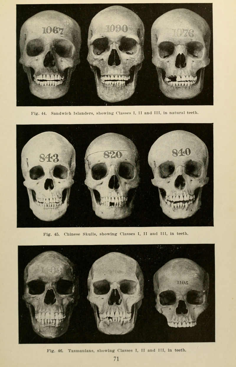 fi ^ -^^^ a » - If*^ ^^^^^^^^k. . ^^^^^Wj^M^'- ,^^^^^^^1 Fig. 44. Sandwich Islanders, showing Classes I, II and III, In natural teeth. Fig. 45. Chinese Skulls, showing Classes I, II and III, in teeth. Fig. 4C. Tu.Huianlaus, showing Classes I, II and III, In teeth.