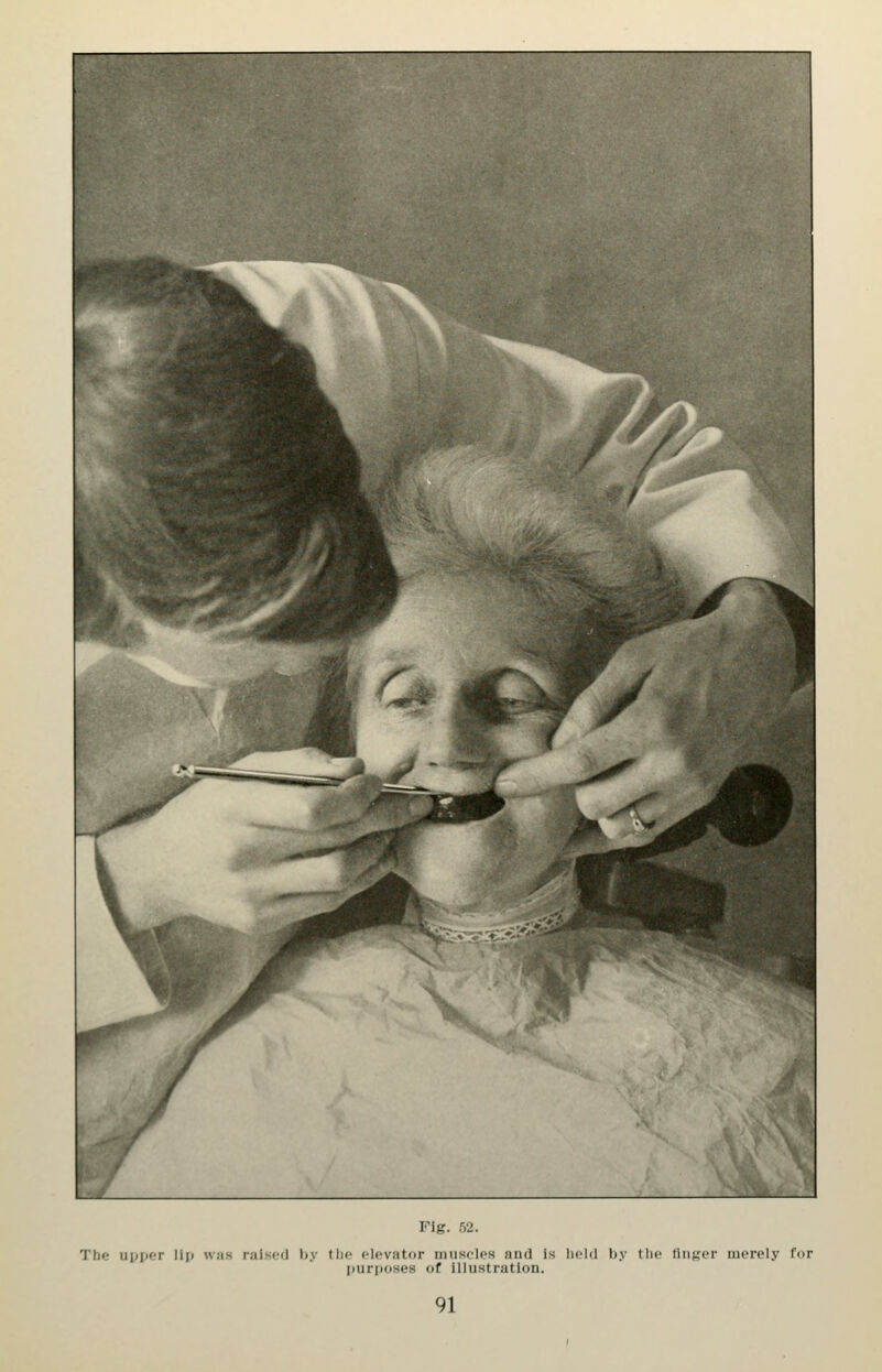 Fig. 52. The upjier li|» was raised by ttio elevator muscles and Is held by the tiiiger merely for purposes of Illustration.