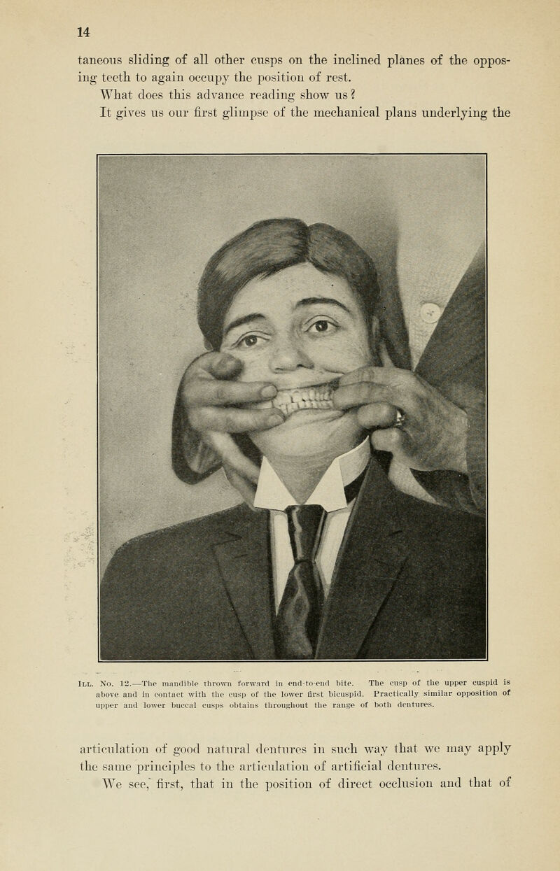 taneous sliding of all other cusps on the inclined planes of the oppos- ing teeth to again occupy the position of rest. What does this advance reading show us ? It gives us our first glimpse of the mechanical plans underlying the III. No. 12.—The mandible thrown forward in end-to-end bite. Tlie cusp of the upper cuspid is above and in contact with the cusp of the lower first bicuspid. Practically similar opposition of upper and lower buccal cusps obtains throughout the range of both dentures. articulation of good natural dentures in such way that we may apply the same principles to the articulation of artificial dentures. We see, first, that in the position of direct occlusion and that of