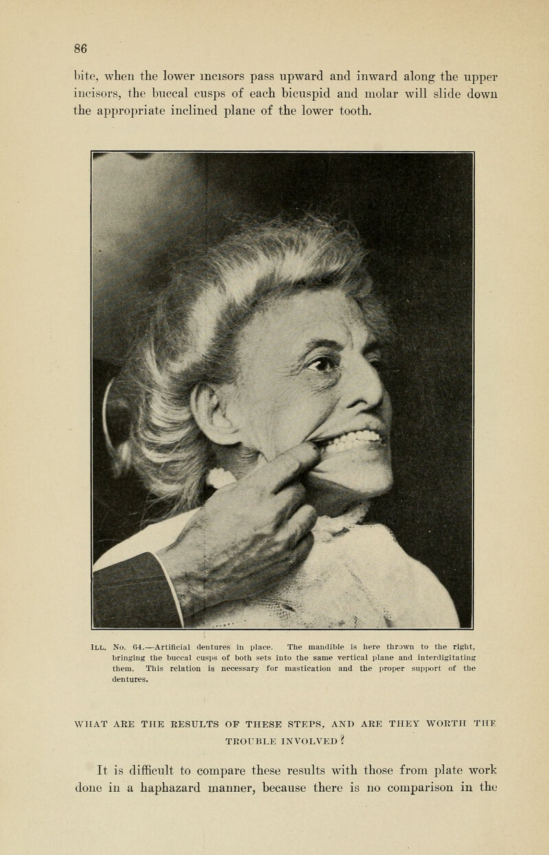 bite, when the lower incisors pass upward and inward along the upper incisors, the buccal cusps of each bicuspid and molar will slide down the appropriate inclined plane of the lower tooth. III. No. 64.—Artificial dentures in place. The mandible is here thrown to the right, bringing the buccal cusps of both sets into the same vertical plane and interdigitating them. This relation is necessary for mastication and the proper support of the dentures. WHAT ARE THE RESULTS OF THESE STEPS^ AND ARE THEY WORTH THE TROUBLE INVOLVED ? It is difficult to compare these results with those from plate work done in a haphazard manner, because there is no comparison in the