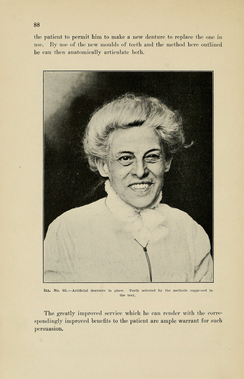 the patient to permit him to make a new denture to replace the one in use. By use of the new moulds of teeth and the method here outlined he can then anatomically articulate both. III. No. 65.—Artificial dentures in place. Teeth selected by tlie methods suggested in the text. The greatly improved service which he can render with the corre- spondingly improved benefits to the patient are ample warrant for such persuasion.