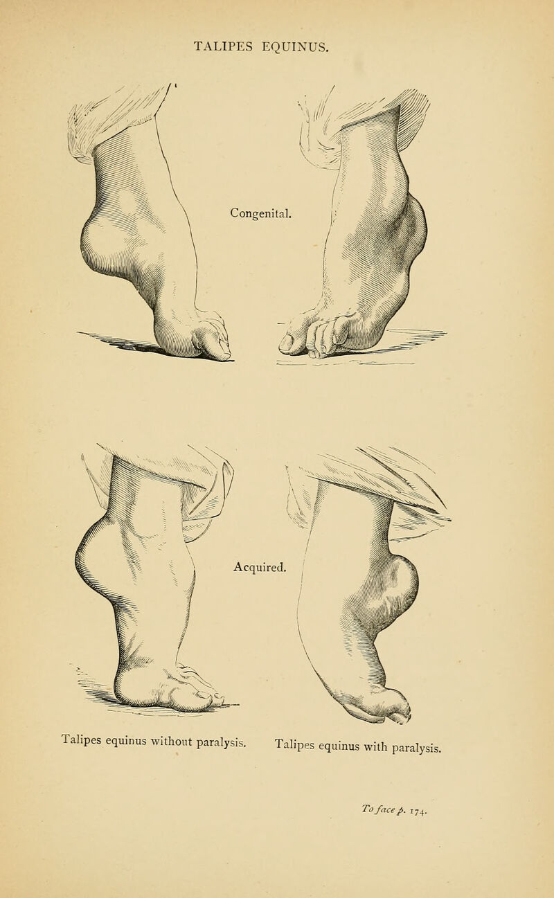 TALIPES EQUINUS. Acquired Talipes equinus without paralysis. Talipes equinus with paralysis.