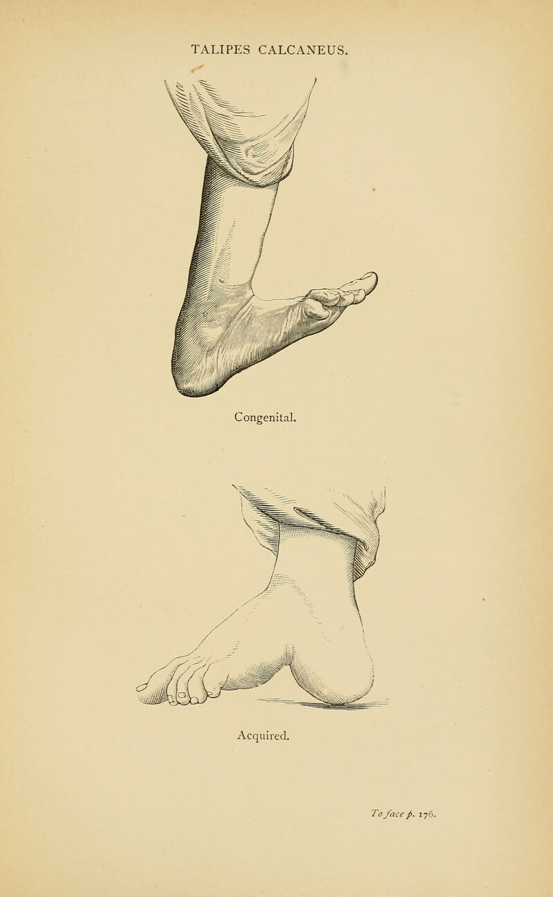TALIPES CALCANEUS. Congenital. Acquired.