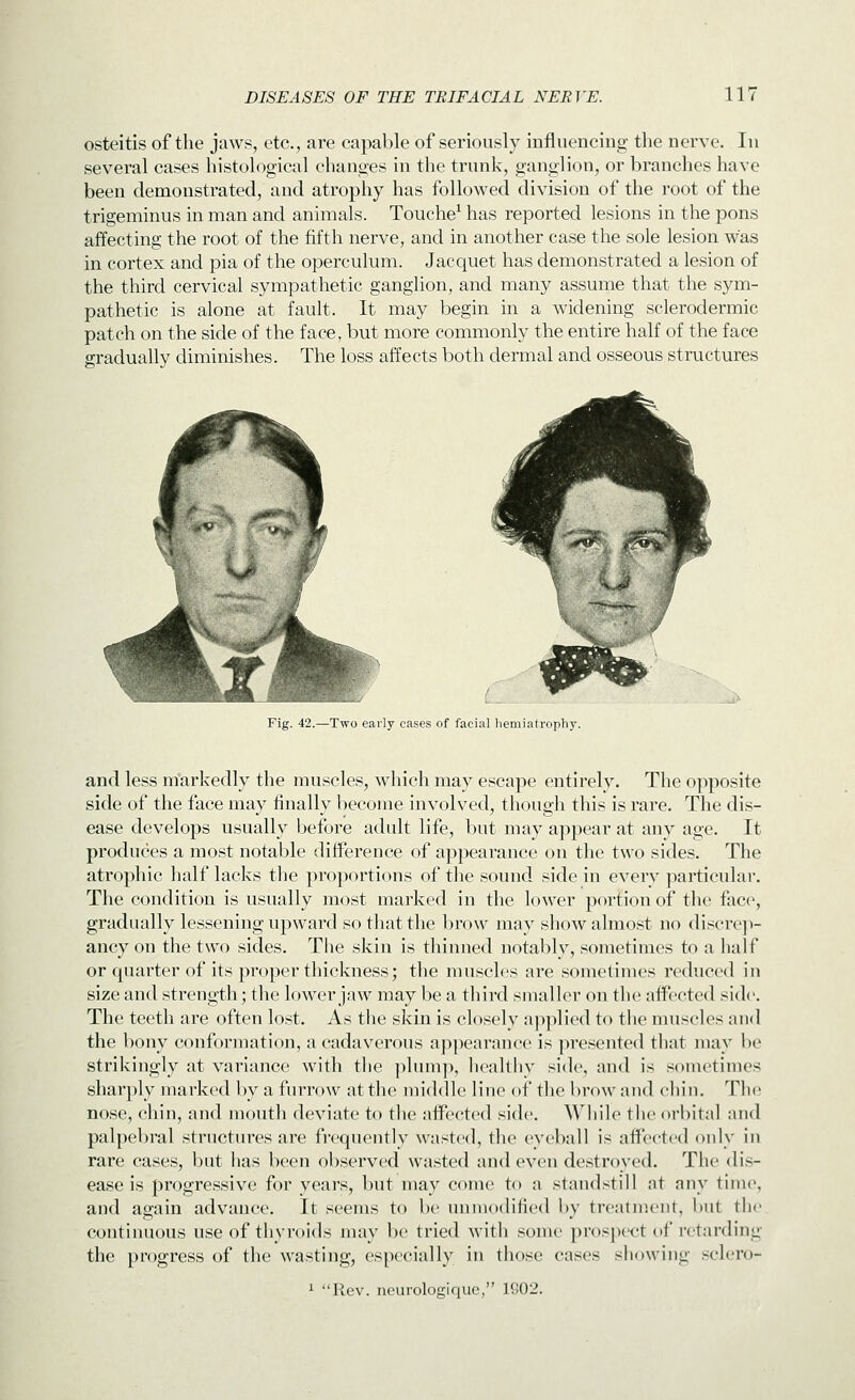 osteitis of the jaws, etc., are capable of seriously influencing the nerve. In several cases histological changes in the trunk, ganglion, or branches have been demonstrated, and atrophy has followed division of the root of the trigeminus in man and animals. Touche^ has reported lesions in the pons affecting the root of the fifth nerve, and in another case the sole lesion was in cortex and pia of the operculum. Jacquet has demonstrated a lesion of the third cervical sympathetic ganglion, and many assume that the sym- pathetic is alone at fault. It may begin in a widening sclerodermic patch on the side of the face, but more commonly the entire half of the face gradually diminishes. The loss affects both dermal and osseous structures Fig. 42.—Two early cases of facial liemiatrophy. and less markedly the muscles, which may escape entirely. The opposite side of the face may finally become involved, though this is rare. The dis- ease develops usually before adult life, but may appear at any age. It produces a most notable difference of appearance on the two sides. The atrophic half lacks the proportions of the sound side in every particular. The condition is usually most marked in the lower portion of the face, gradually lessening upward so that the brow may show almost no discrep- ancy on the two sides. The skin is thinned notably, sometimes to a lialf or quarter of its proper thickness; the muscles are sometimes reduced in size and strength; the lower jaw may be a third smaller on the affected sid(\ The teeth are often lost. As the skin is closely a])plicd to the nniscles and the bony conformation, a cadaverous a]>pearance is ]iresente(l that may be strikingly at variance with the plump, healtliy side, and is sometimes sharply marked by a furrow at the middle line of the brow and chin. The nose, chin, and mouth deviate to the affected side. While the orbital and palpebral structures are fi-cquently wasted, the eyeball is affected only in rare cases, but has been observed wasted and even destroyed. The dis- ease is progressive for years, but may come to a standstill at any time, and again advance. It seems to be unmodified by treatment, but the. continuous use of thyroids may be tried with some prospect of retarding the progress of the wasting, especially in those cases showing sclero- 1 Rev. neurologiquc, 1902.